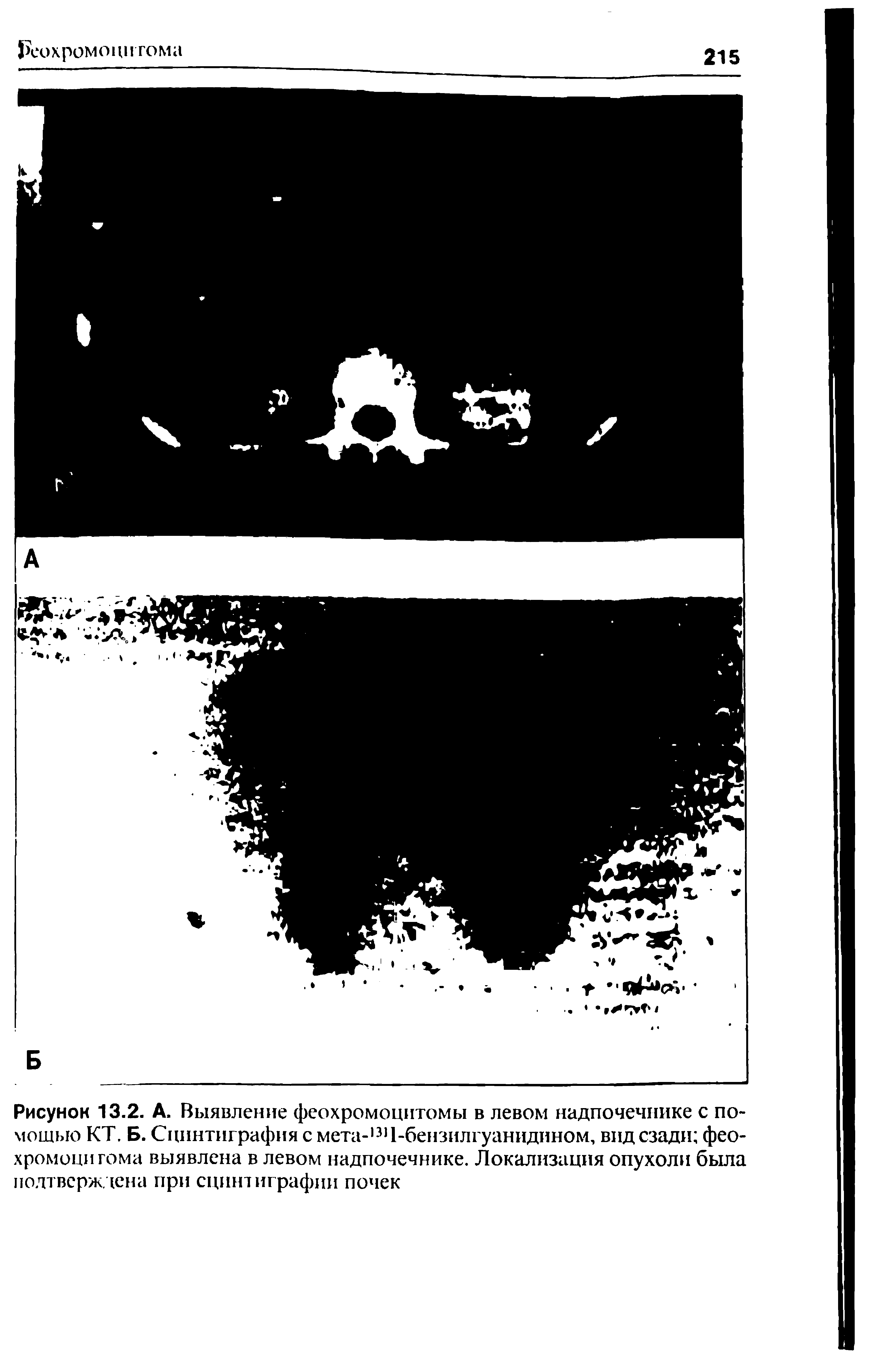 Рисунок 13.2. А. Выявление феохромоцитомы в левом надпочечнике с помощью КТ. Б. Сцинтиграфия с мета-1311-бензилгуанидином, вид сзади фео-хромоцигома выявлена в левом надпочечнике. Локализация опухоли была подтверждена при сцинтиграфии почек...