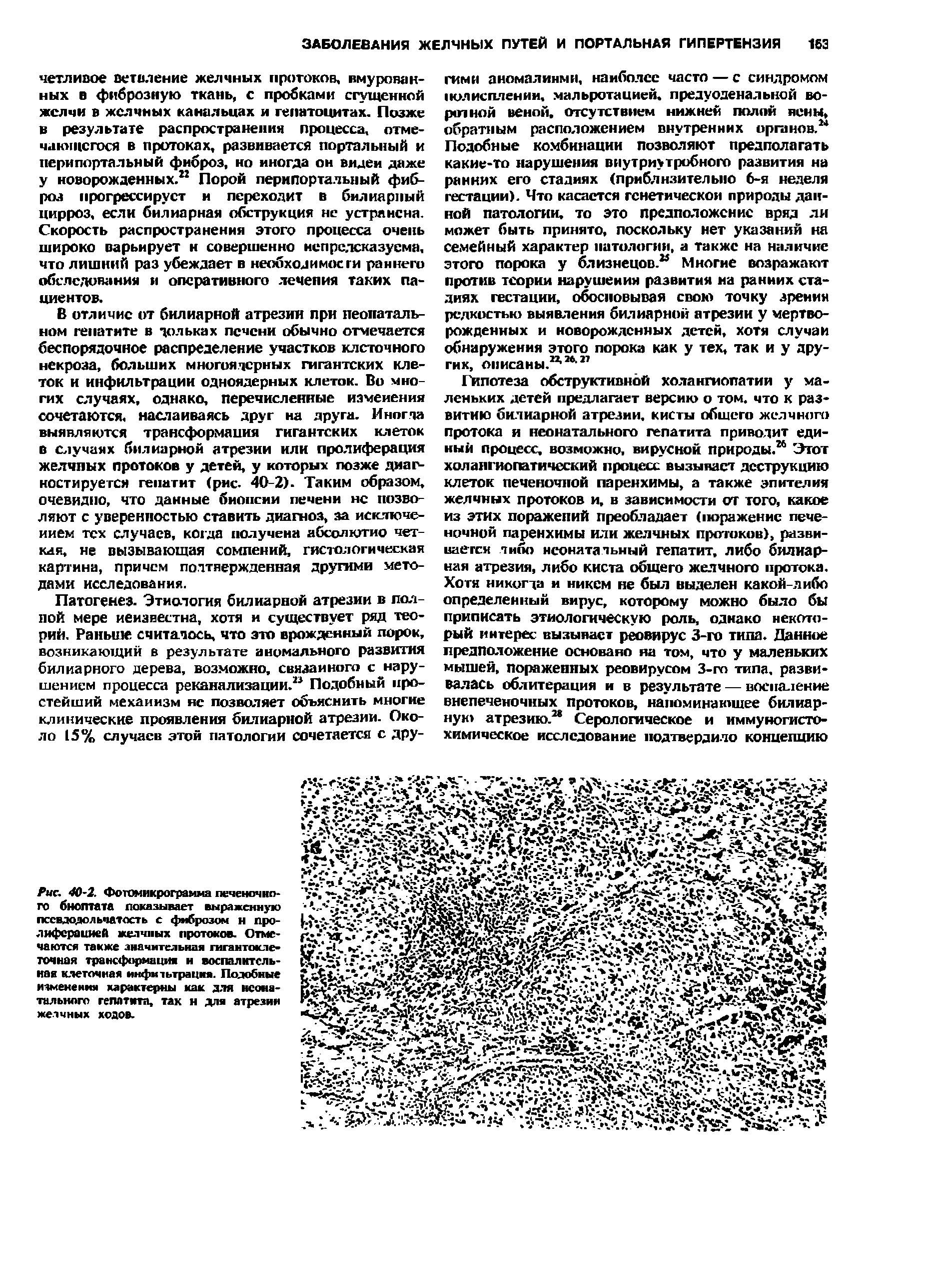 Рис. 40 2. Фотомикрограмма печеночного бноптата показывает выраженную пссадодольчатость с фиброзом н пролиферацией желчных протоков. Отмечаются также значительная гигантоклеточная трансформация и воспалительная клеточная инфитьтрация. Подобные изменения характерны как для неонатального гепатита, так н для атрезии желчных ходов.
