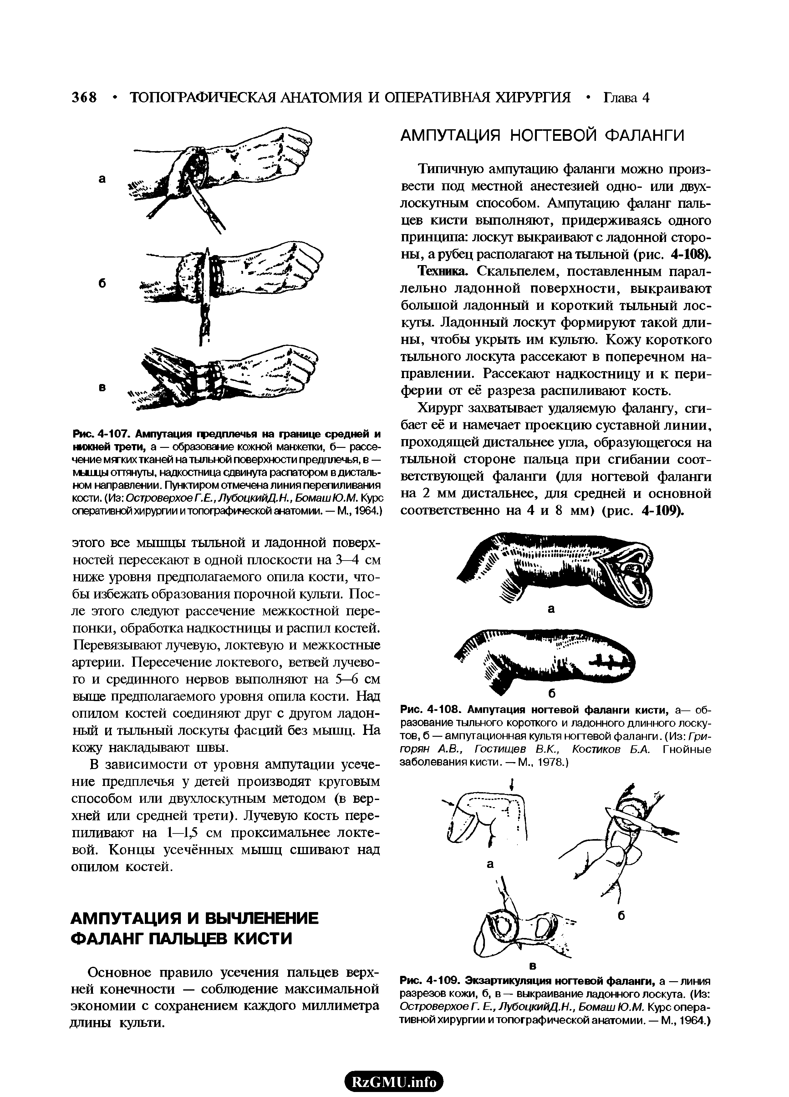 Рис. 4-108. Ампутация ногтевой фаланги кисти, а— образование тыльного короткого и ладонного длинного лоскутов, б — ампутационная культя ногтевой фаланги. (Из Гри-горян А.В., Гостищев В.К., Костиков Б.А. Гнойные заболевания кисти. —М., 1978.)...