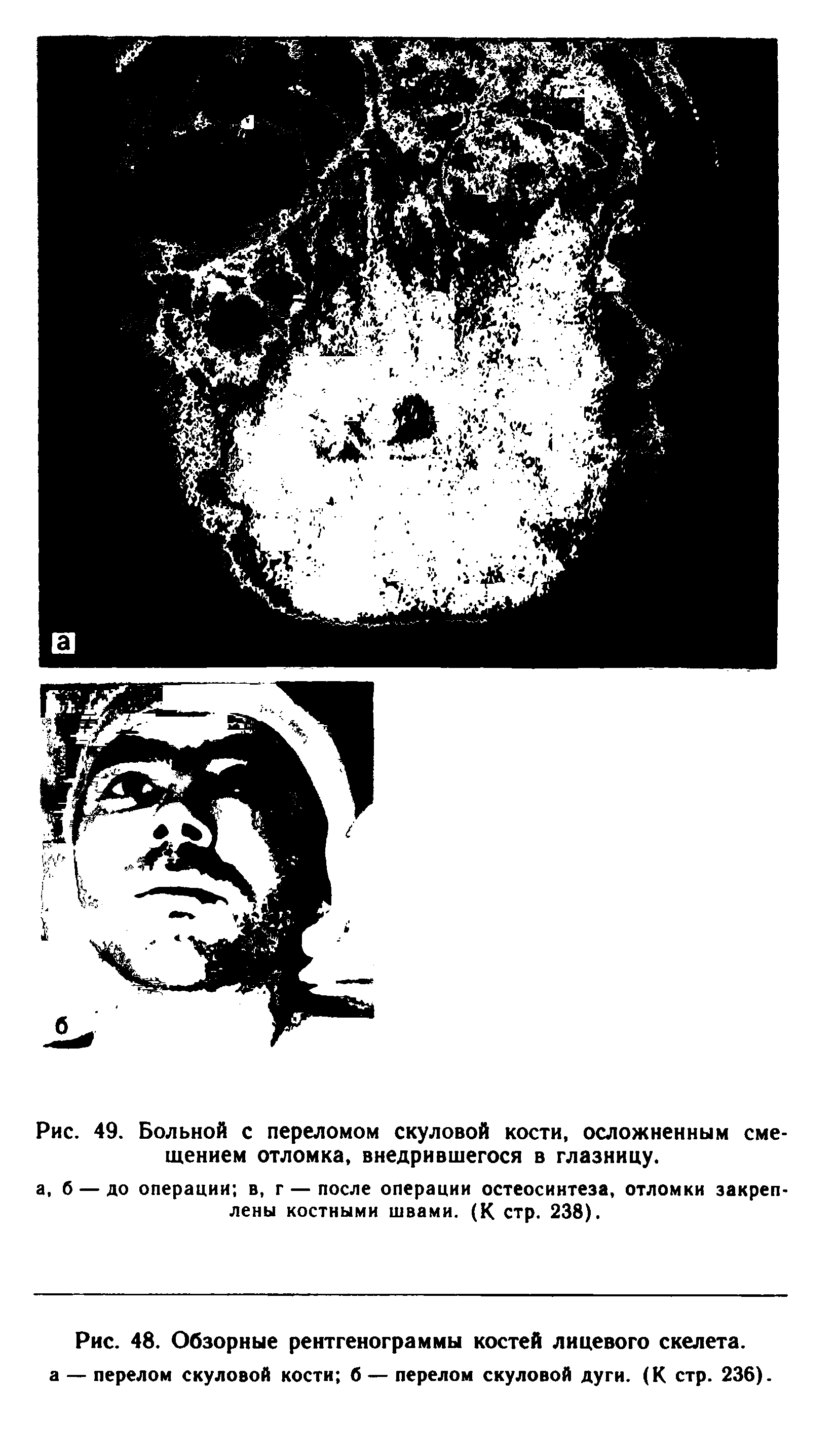 Рис. 48. Обзорные рентгенограммы костей лицевого скелета, а — перелом скуловой кости б — перелом скуловой дуги. (К стр. 236).