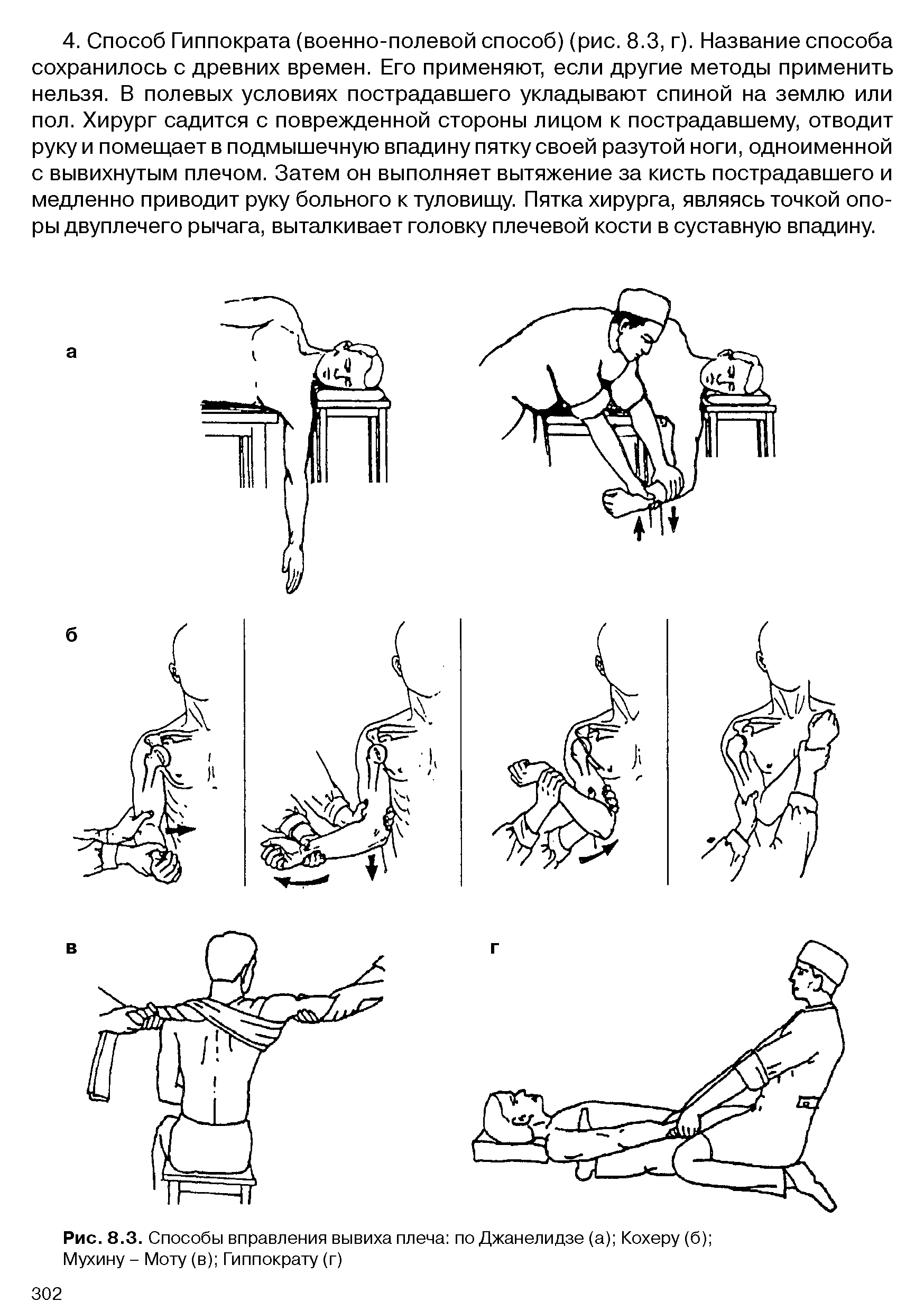 Рис. 8.3. Способы вправления вывиха плеча по Джанелидзе (а) Кохеру (б) Мухину - Моту (в) Гиппократу (г)...