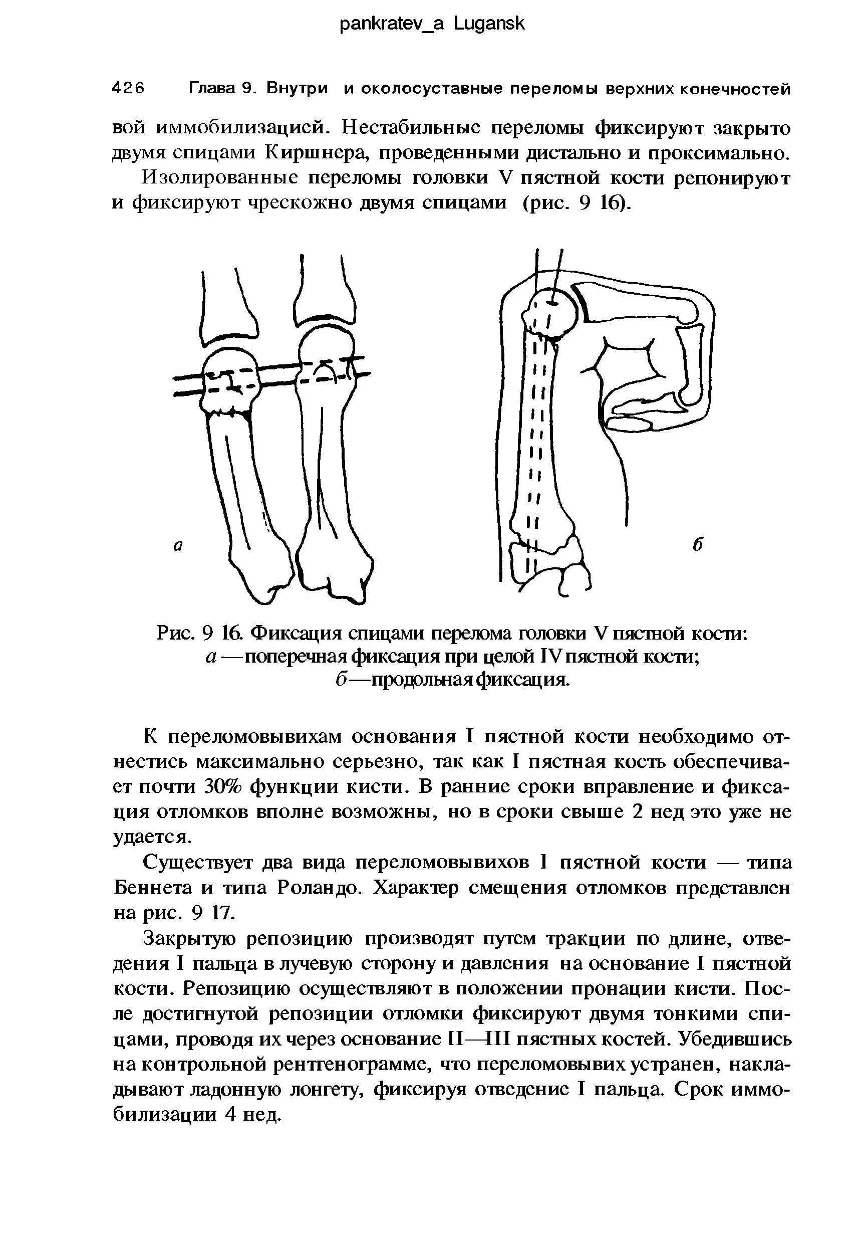 Рис. 9 16. Фиксация спицами перелома головки V пястной кости а —поперечная фиксация при целой IV пястной кости б—продольная фиксация.