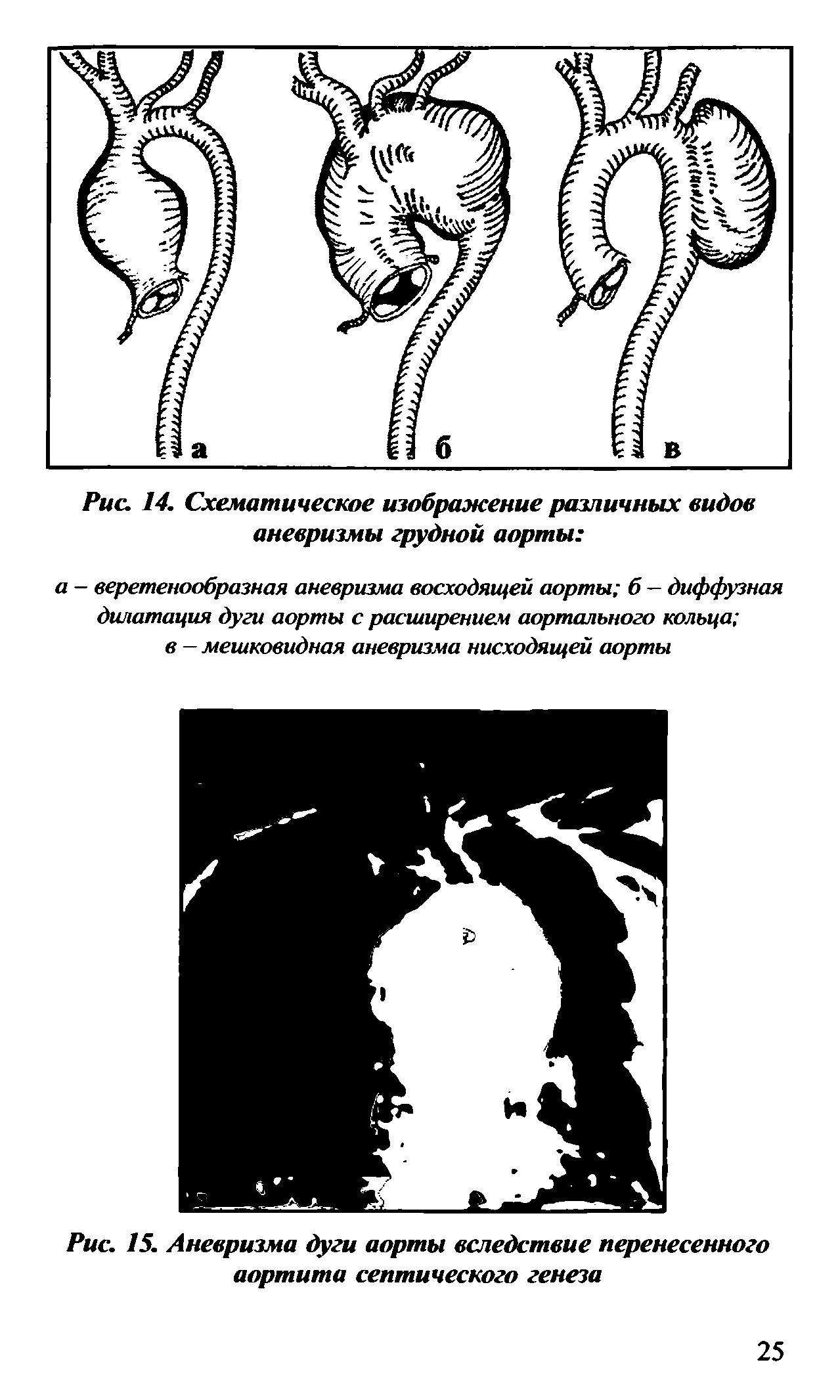 Рис. 15. Аневризма дуги аорты вследствие перенесенного аортита септического генеза...