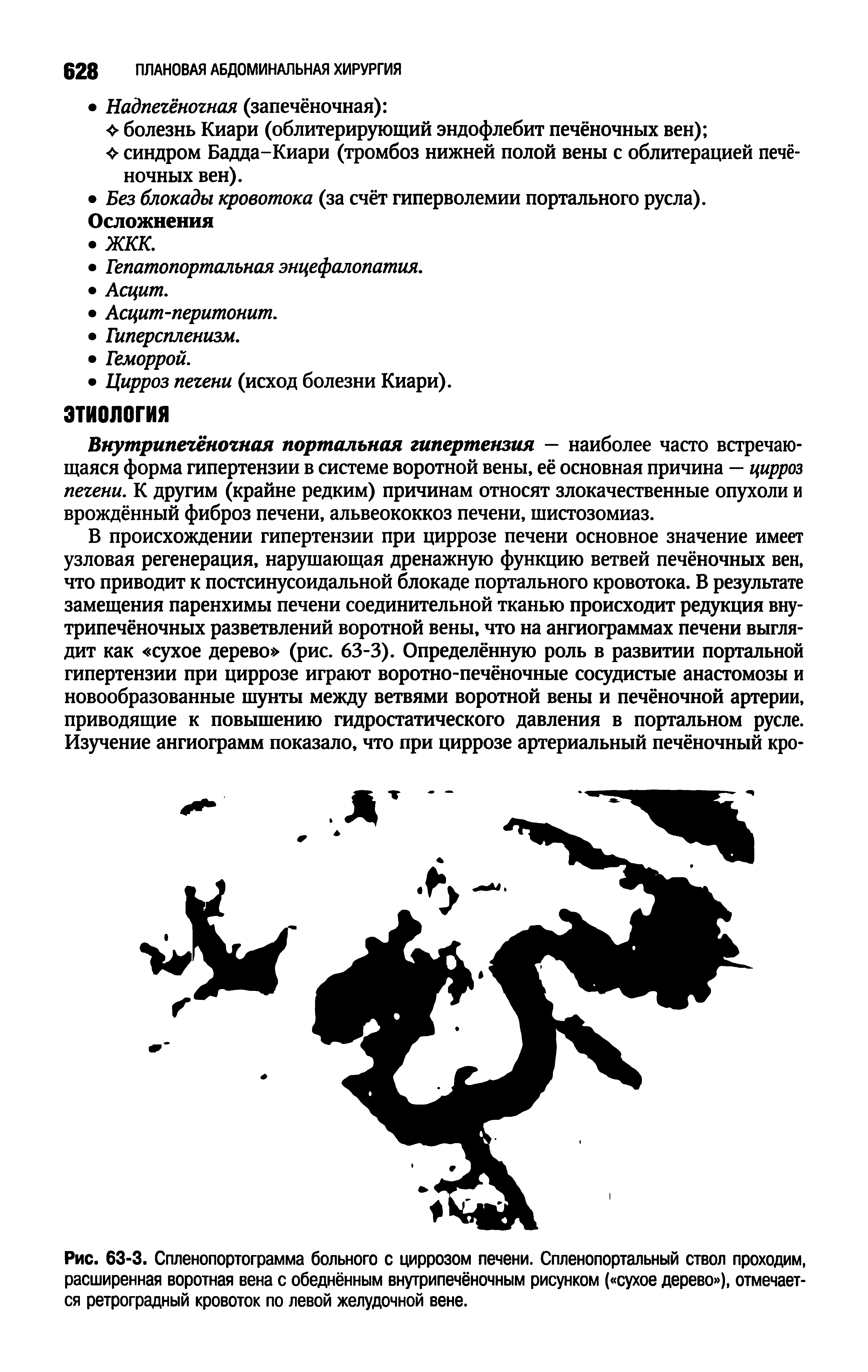 Рис. 63-3. Спленопортограмма больного с циррозом печени. Спленопортальный ствол проходим, расширенная воротная вена с обеднённым внугрипечёночным рисунком ( сухое дерево ), отмечается ретроградный кровоток по левой желудочной вене.