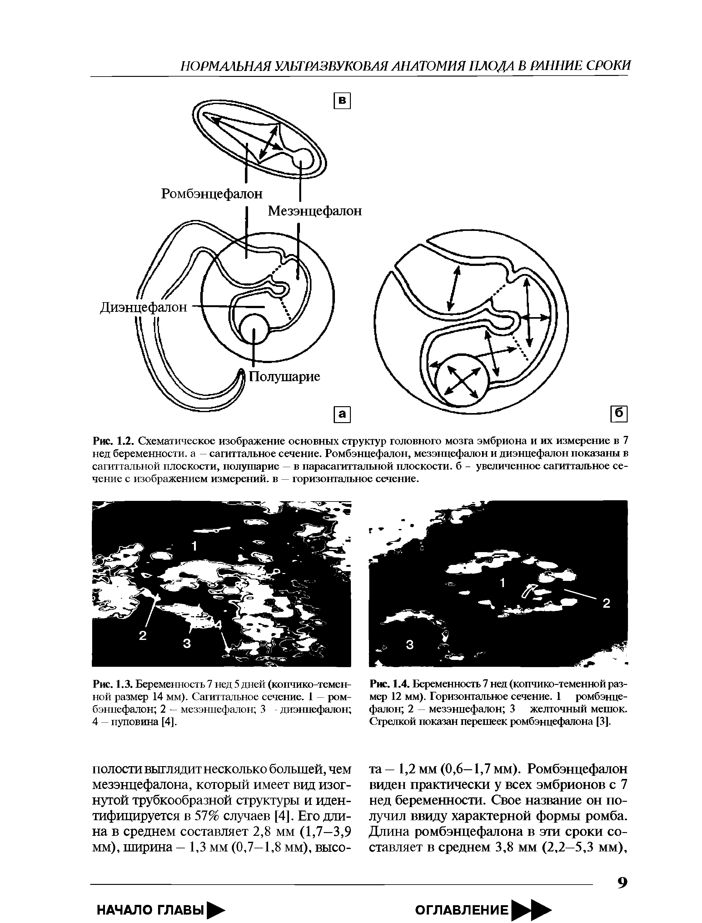 Рис. 1.4. Беременность 7 нед (копчико-теменной размер 12 мм). Горизонтальное сечение. 1 ромбэнцефалон 2 — мезэнцефалон 3 желточный мешок. Стрелкой показан перешеек ромбэнцефалона [3].