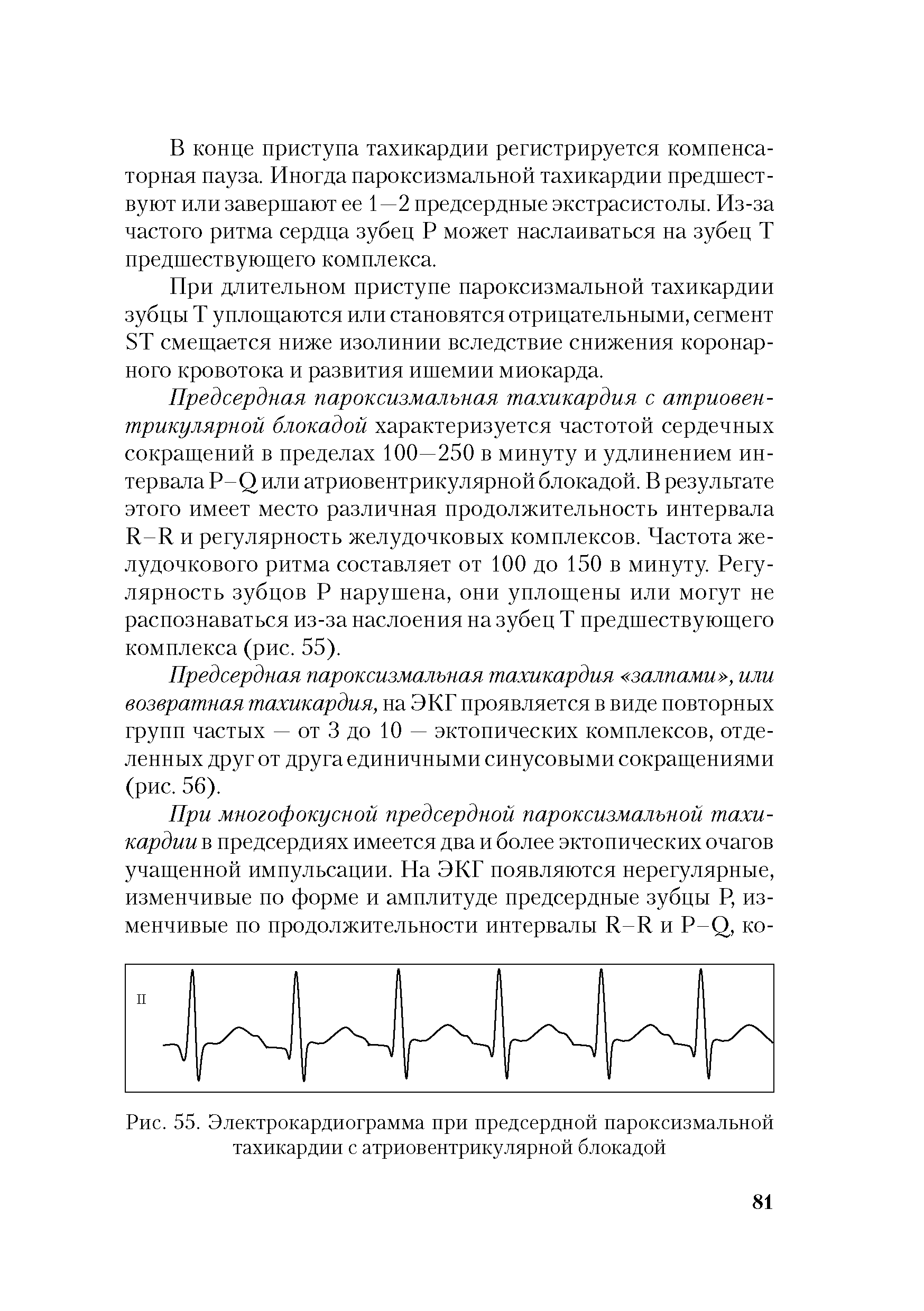 Рис. 55. Электрокардиограмма при предсердной пароксизмальной тахикардии с атриовентрикулярной блокадой...