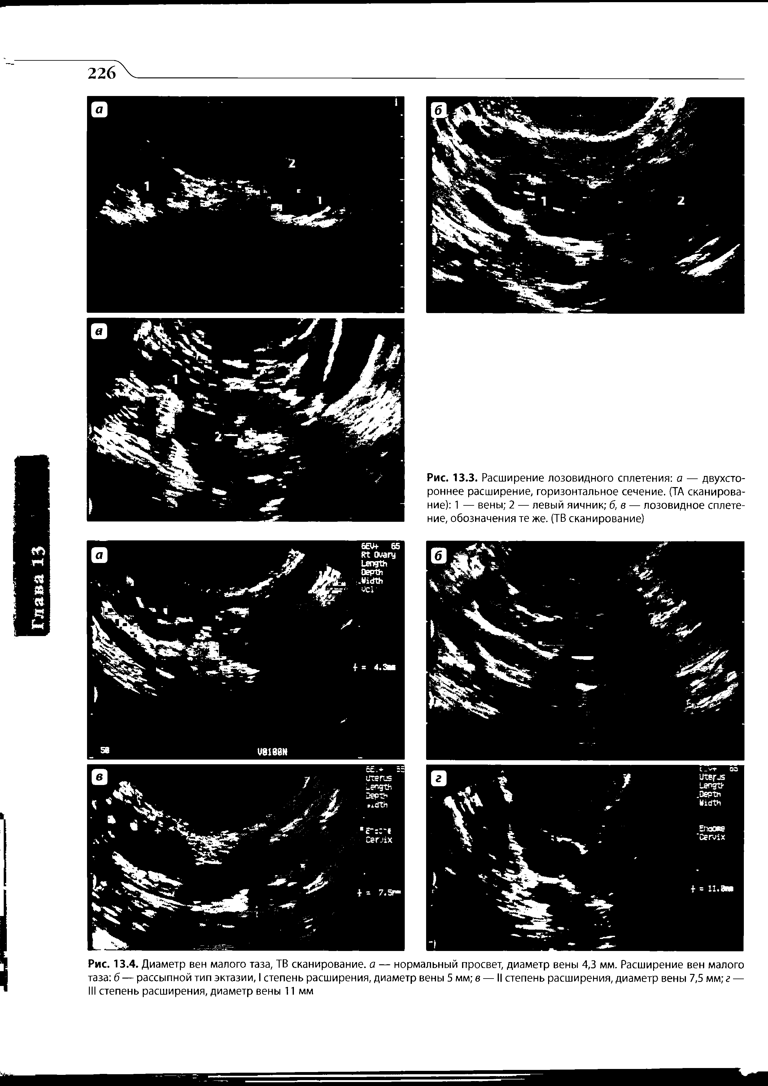 Рис. 13.4. Диаметр вен малого таза, ТВ сканирование, а — нормальный просвет, диаметр вены 4,3 мм. Расширение вен малого таза б — рассыпной тип эктазии, I степень расширения, диаметр вены 5 мм в — II степень расширения, диаметр вены 7,5 мм г — III степень расширения, диаметр вены 11 мм...