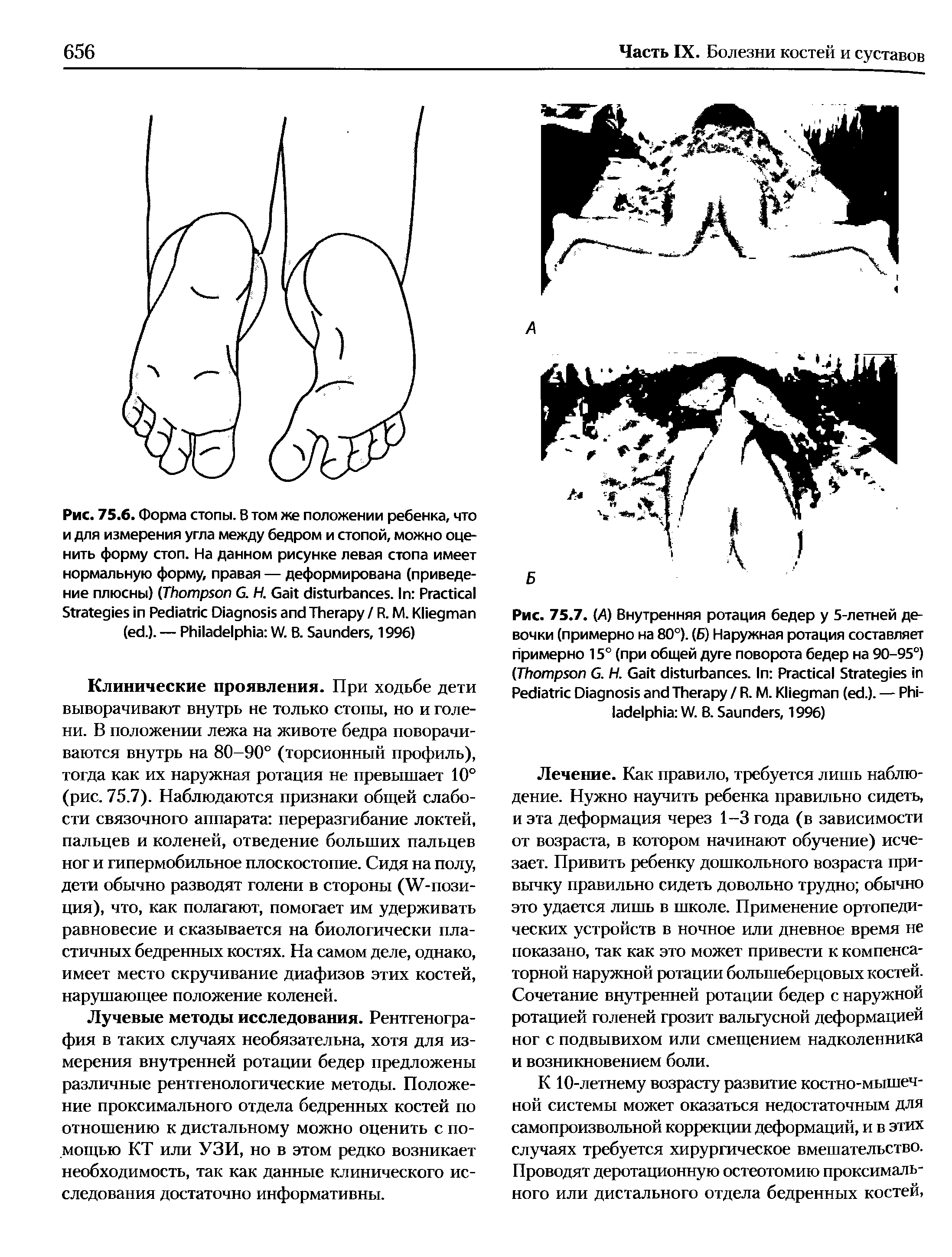 Рис. 75.7. (А) Внутренняя ротация бедер у 5-летней девочки (примерно на 80°). (Б) Наружная ротация составляет примерно 15° (при общей дуге поворота бедер на 90-95°) (T G. Н. G . I P S P D T / R. M. K ( .). — P W. B. S , 1996)...