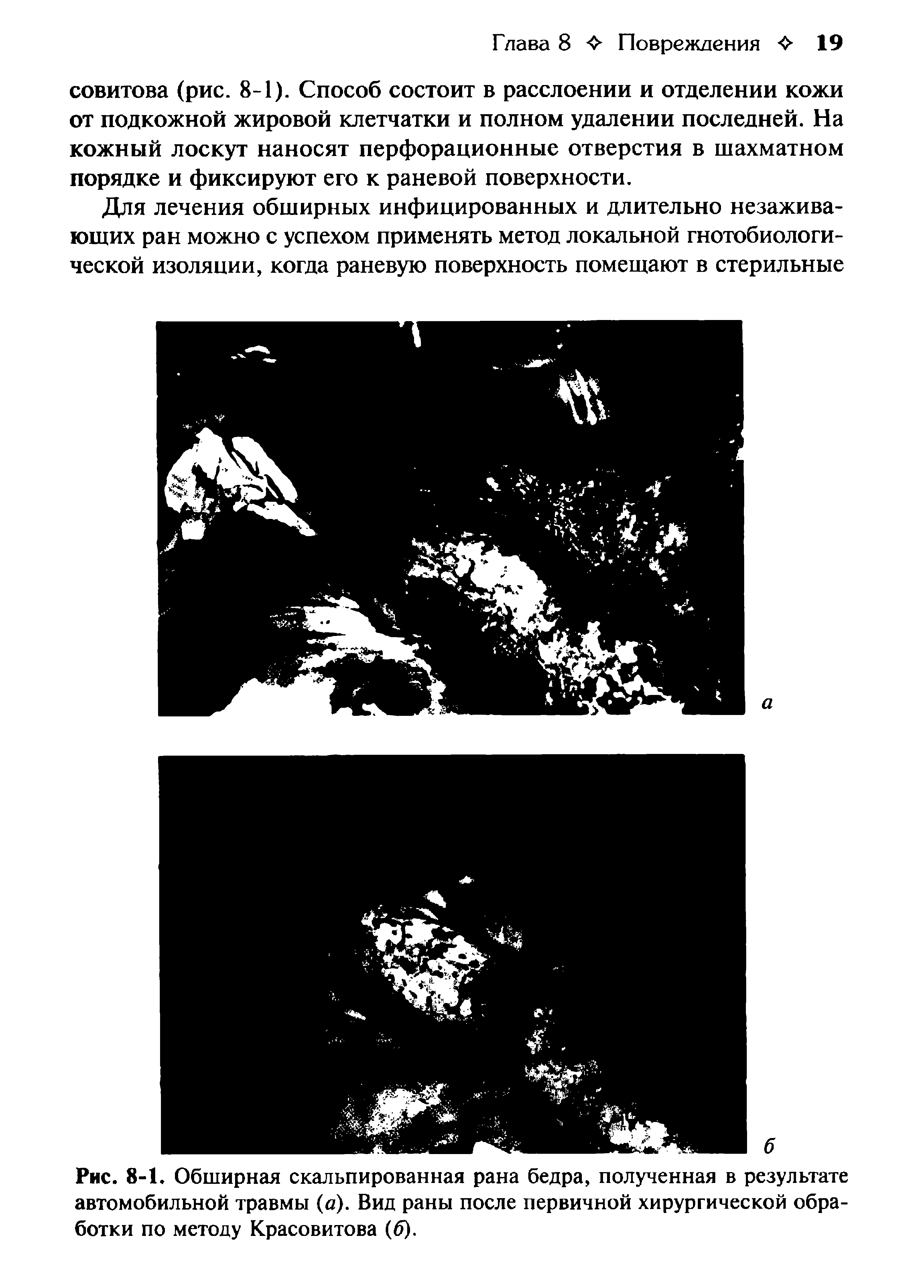 Рис. 8-1. Обширная скальпированная рана бедра, полученная в результате автомобильной травмы (а). Вид раны после первичной хирургической обработки по методу Красовитова (б).