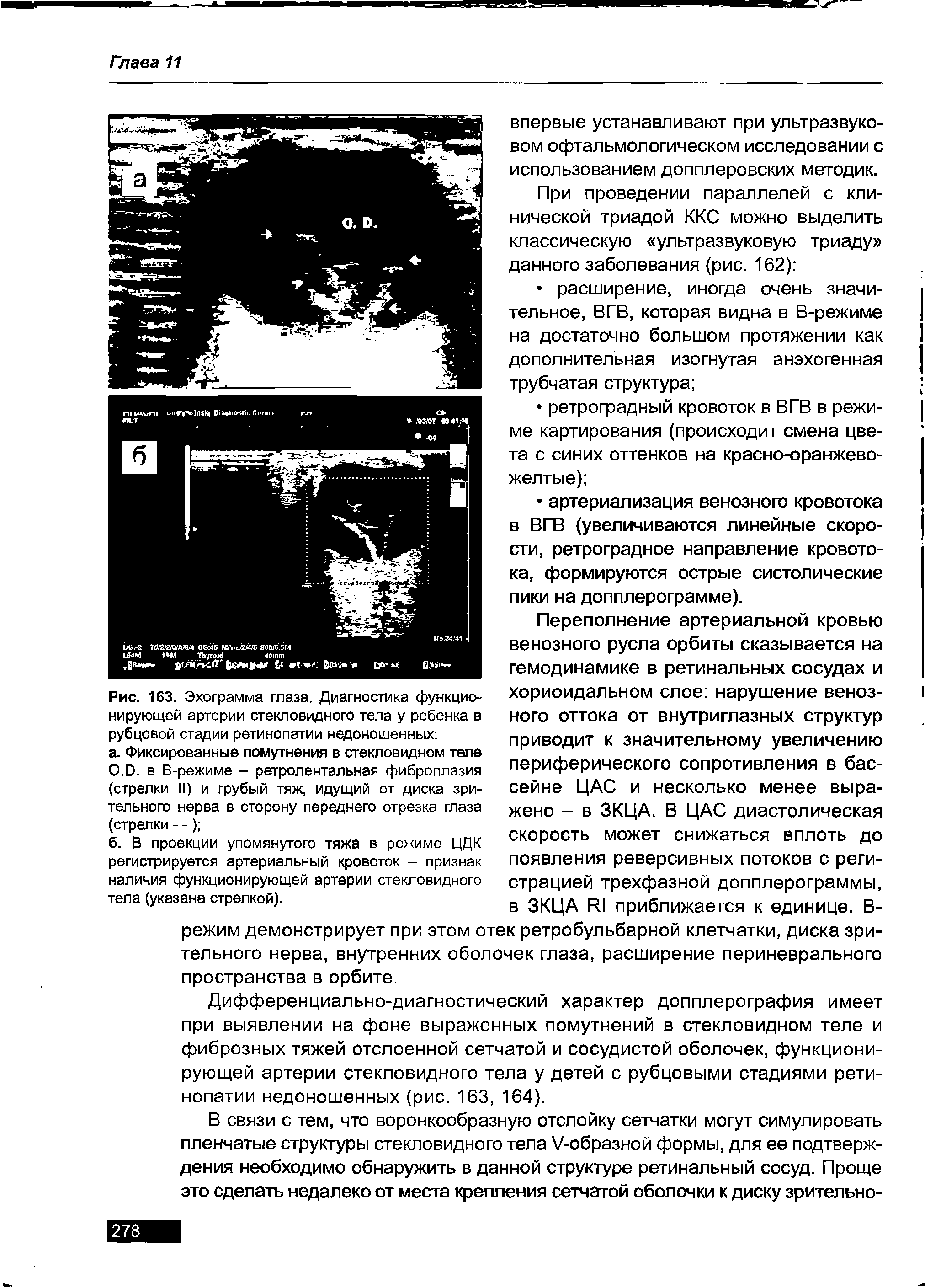 Рис. 163. Эхограмма глаза. Диагностика функционирующей артерии стекловидного тела у ребенка в рубцовой стадии ретинопатии недоношенных ...