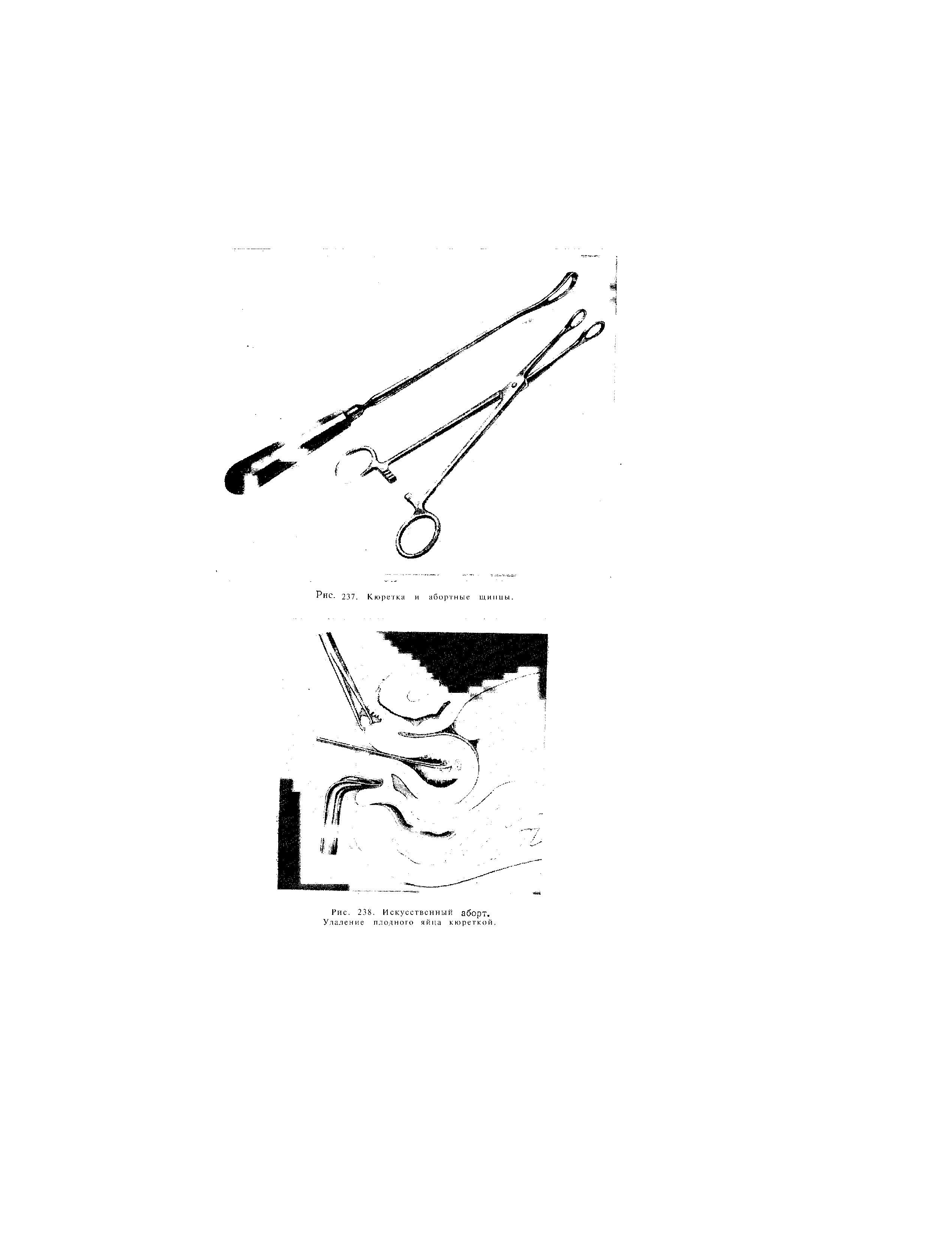 Рис. 238. Искусственный аборт. Удаление плодного яйца кюреткой.