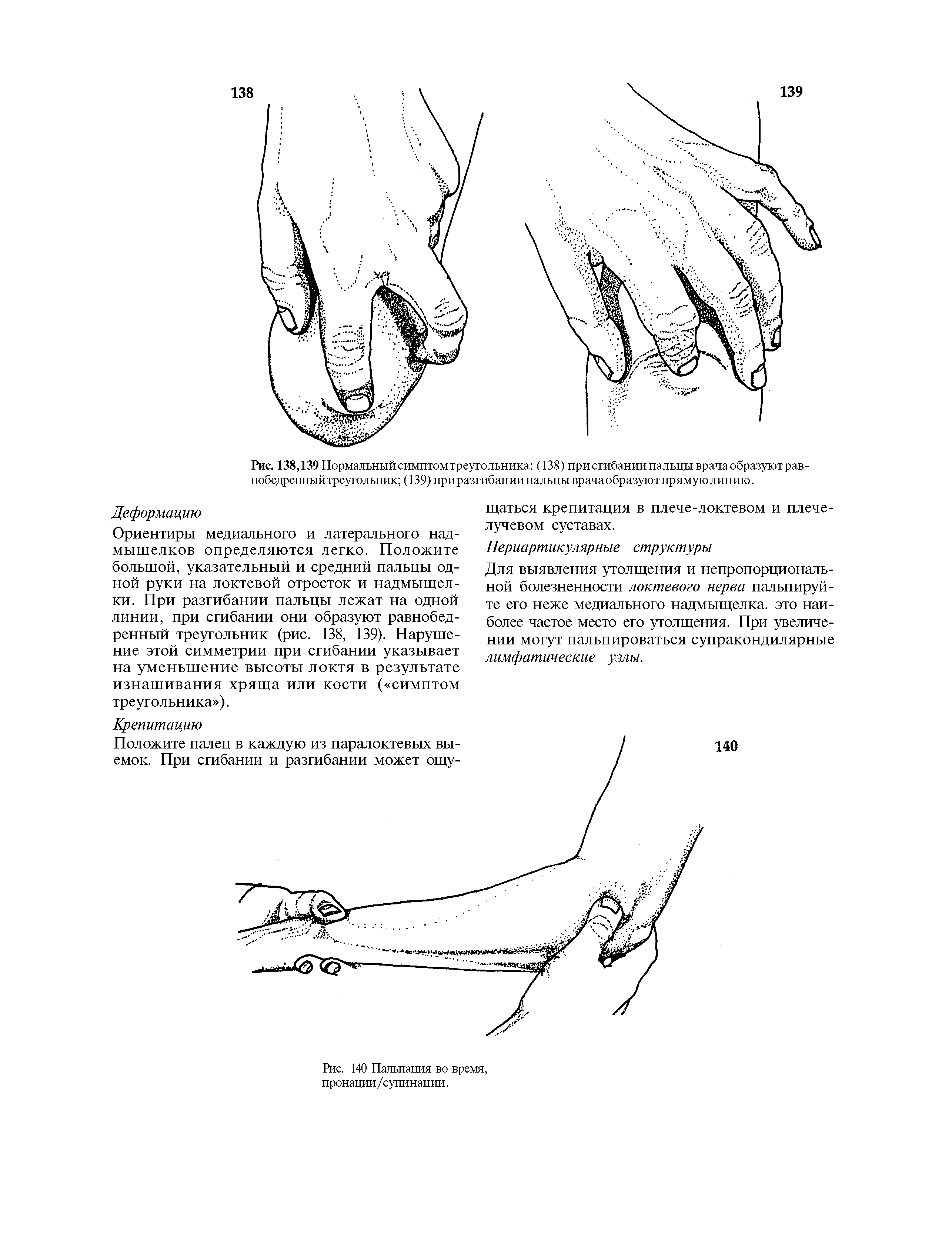 Рис. 138,139 Нормальный симптом треугольника (138) при сгибании пальцы врача образуют равнобедренный треугольник (139) приразгибании пальцы врача образуют прямую линию.