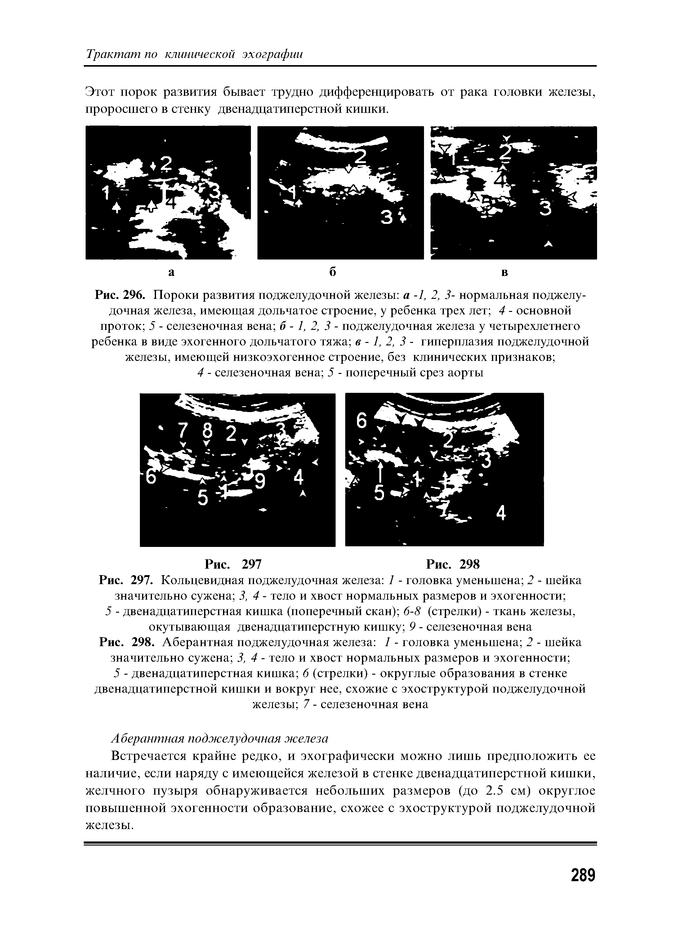 Рис. 296. Пороки развития поджелудочной железы а -1, 2, 3- нормальная поджелудочная железа, имеющая дольчатое строение, у ребенка трех лет 4 - основной проток 5 - селезеночная вена 6-1,2, 3 - поджелудочная железа у четырехлетнего ребенка в виде эхогенного дольчатого тяжа в -1, 2, 3 - гиперплазия поджелудочной железы, имеющей низкоэхогенное строение, без клинических признаков ...