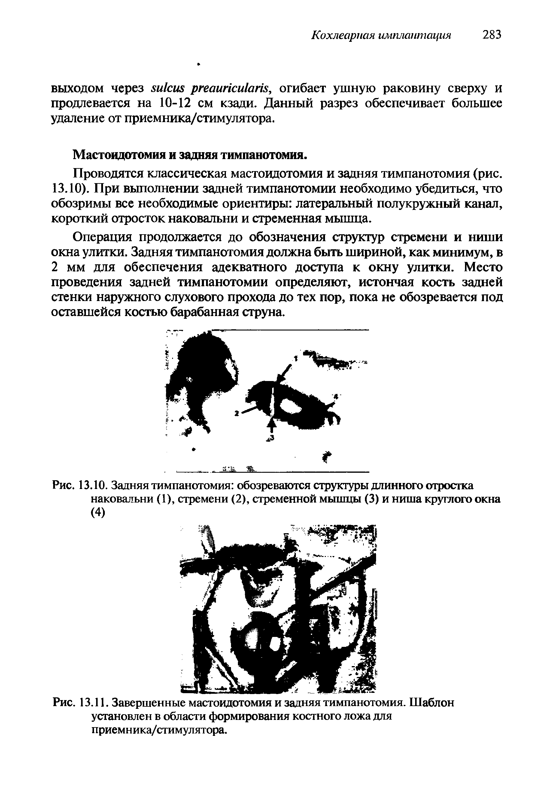 Рис. 13.10. Задняя тимпанотомия обозреваются структуры длинного отростка наковальни (1), стремени (2), стременной мышцы (3) и ниша круглого окна (4)...