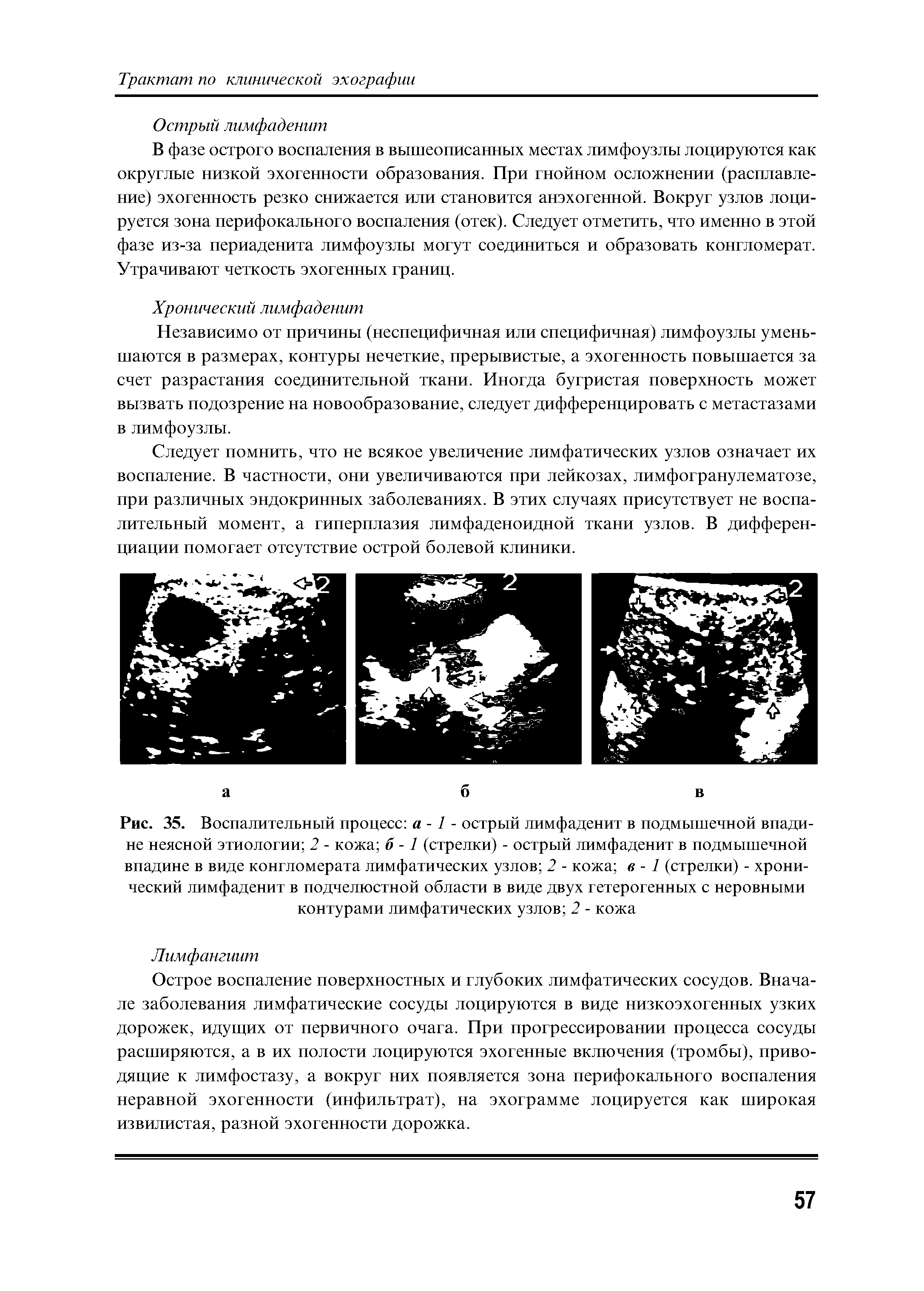 Рис. 35. Воспалительный процесс а -1 - острый лимфаденит в подмышечной впадине неясной этиологии 2 - кожа б -1 (стрелки) - острый лимфаденит в подмышечной впадине в виде конгломерата лимфатических узлов 2 - кожа в - 1 (стрелки) - хронический лимфаденит в подчелюстной области в виде двух гетерогенных с неровными контурами лимфатических узлов 2 - кожа...