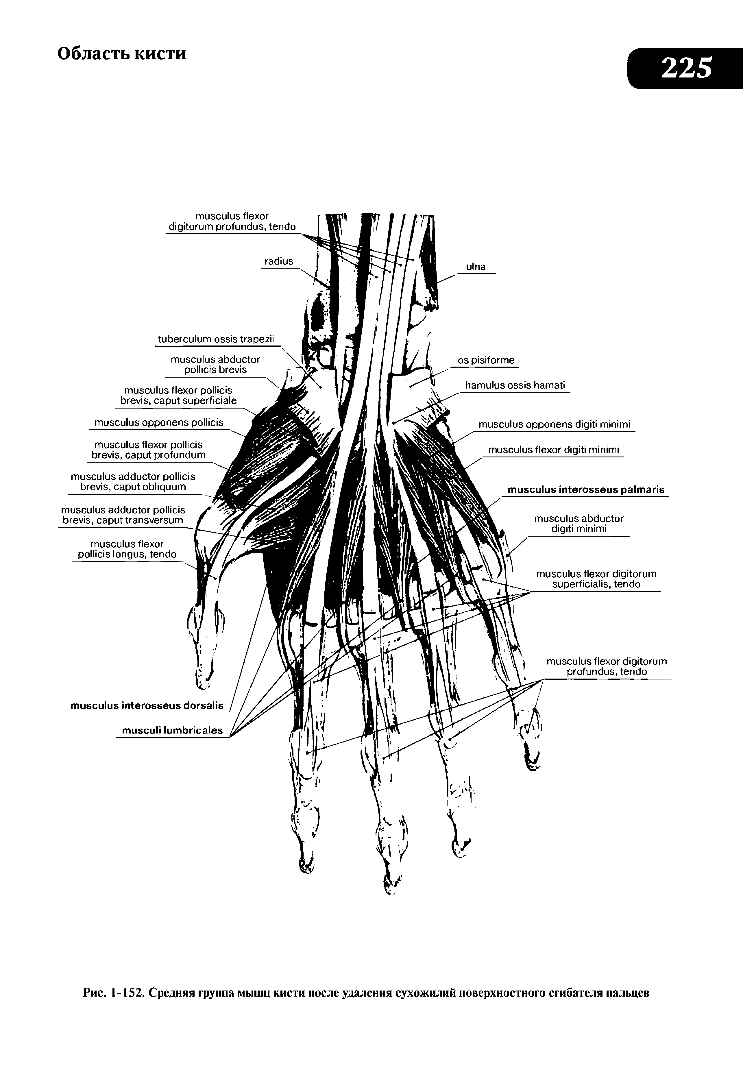 Рис. 1-152. Средняя группа мышц кисти после удаления сухожилий поверхностного сгибателя пальцев...