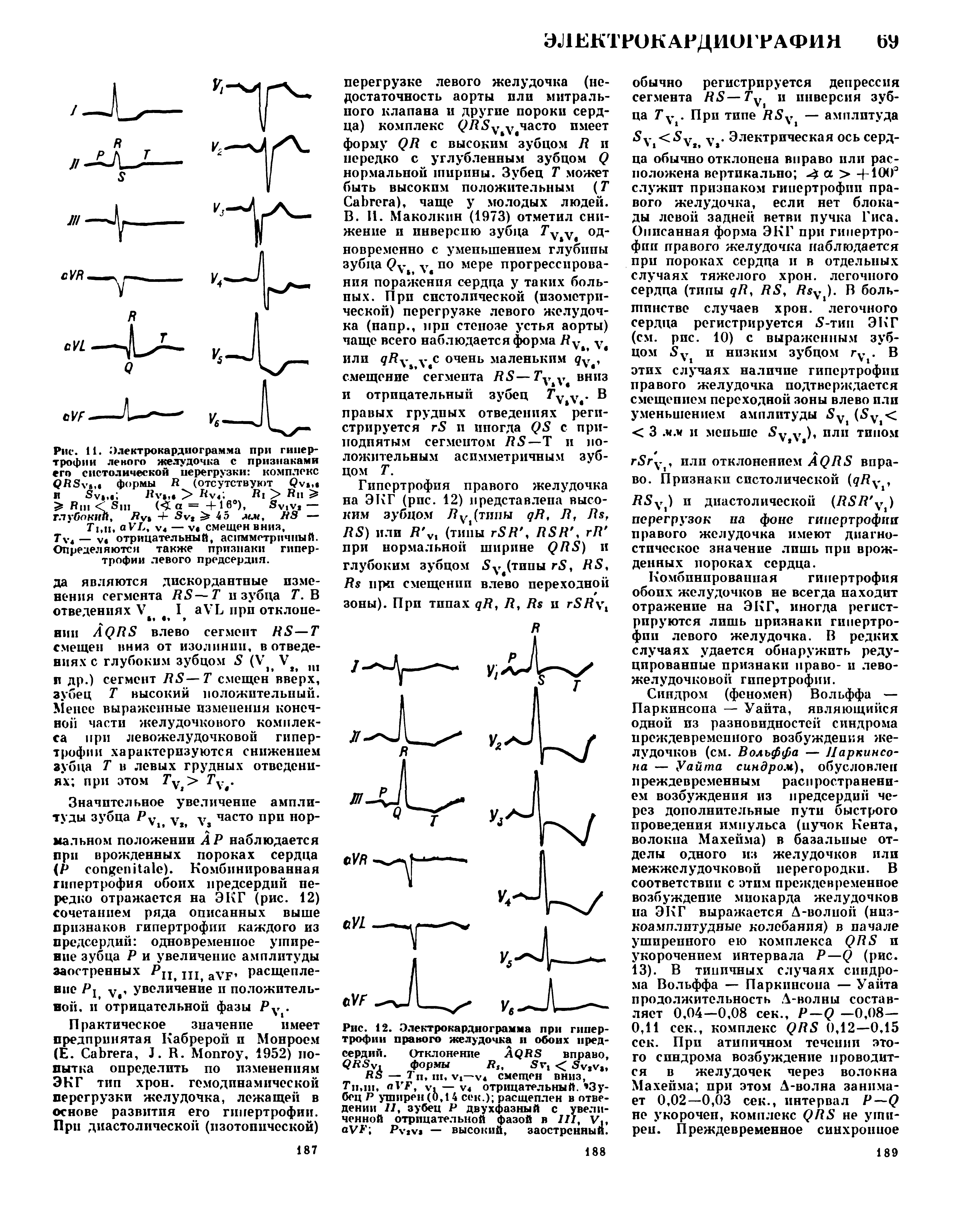 Рис. 11. Электрокардиограмма при гипертрофии левого желудочка с признаками его систолической перегрузки комплекс Q S формы R (отсутствуют Q , и S ., B .,. > R R > R >...