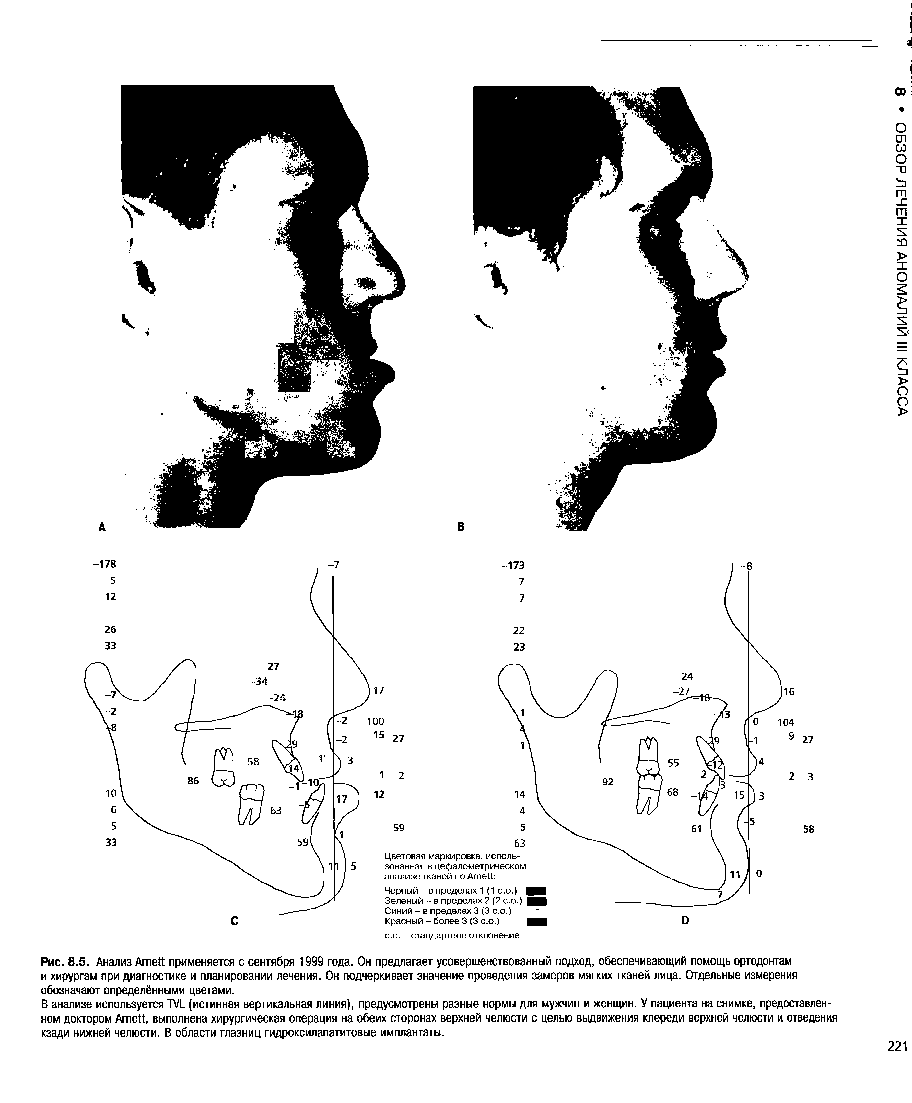 Рис. 8.5. Анализ A применяется с сентября 1999 года. Он предлагает усовершенствованный подход, обеспечивающий помощь ортодонтам и хирургам при диагностике и планировании лечения. Он подчеркивает значение проведения замеров мягких тканей лица. Отдельные измерения обозначают определёнными цветами.