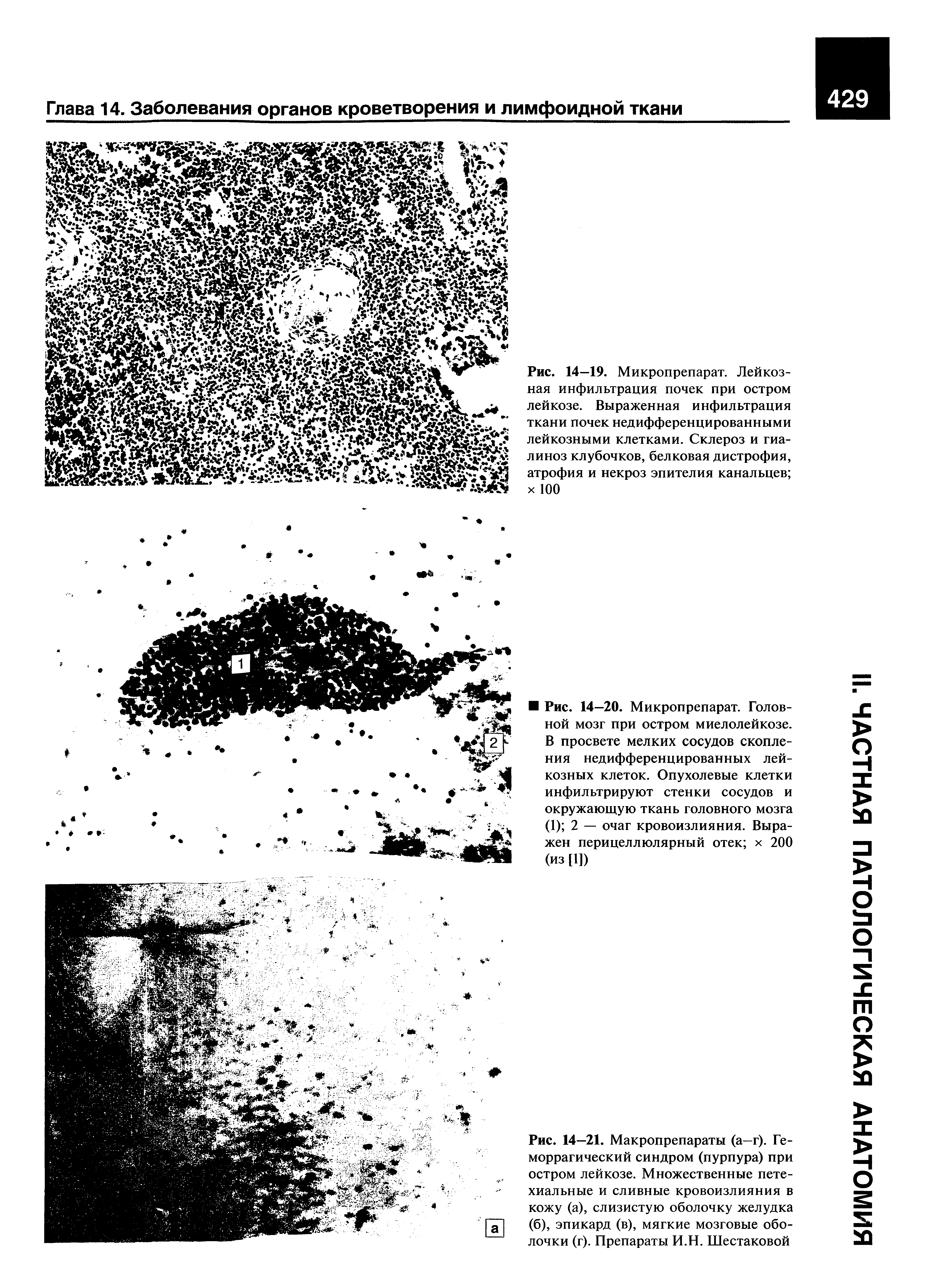 Рис. 14—21. Макропрепараты (а—г). Геморрагический синдром (пурпура) при остром лейкозе. Множественные петехиальные и сливные кровоизлияния в кожу (а), слизистую оболочку желудка (б), эпикард (в), мягкие мозговые оболочки (г). Препараты И.Н. Шестаковой...