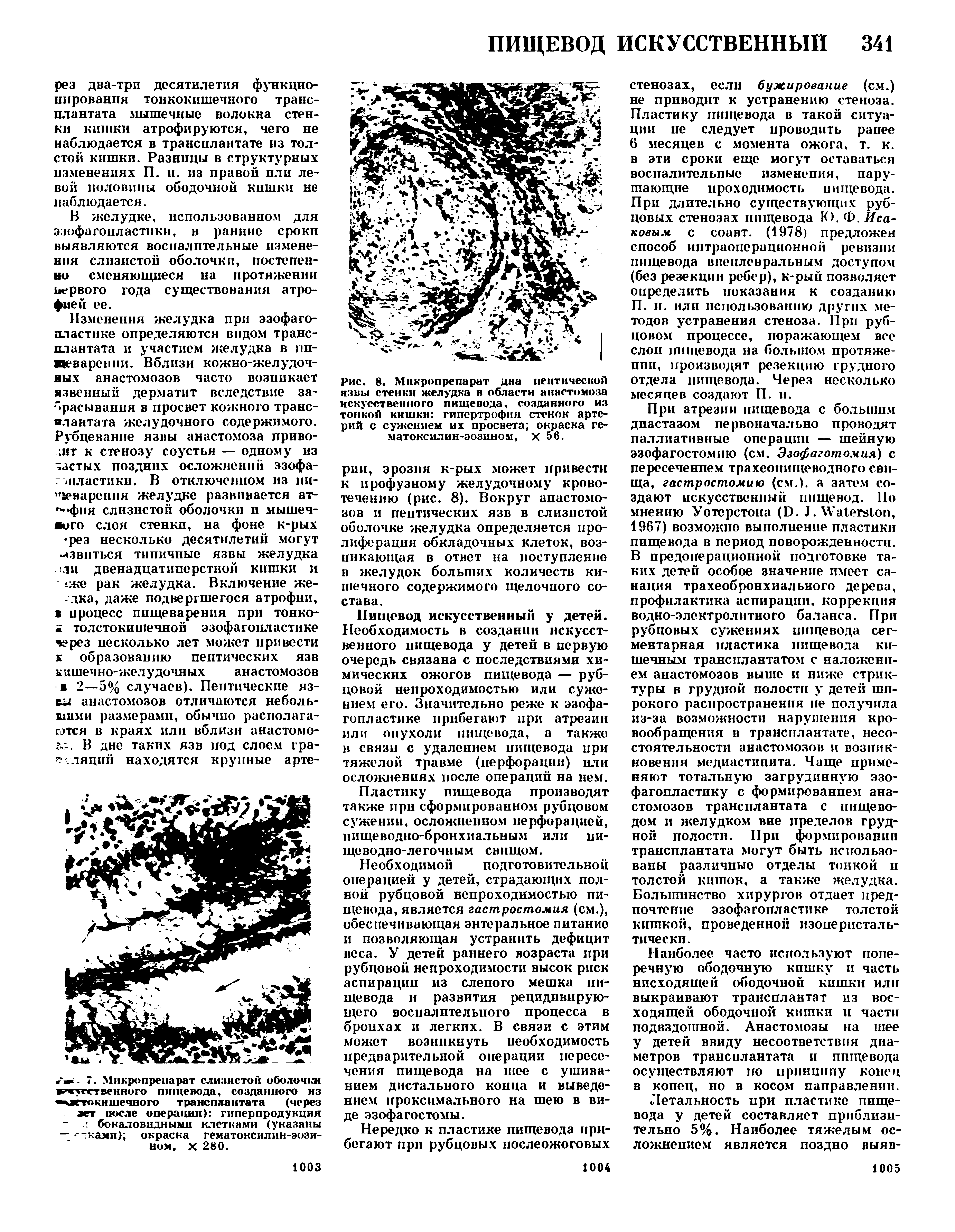 Рис. 8. Микропрепарат дна пептической язвы стенки желудка в области анастомоза искусственного пищевода, созданного из тонкой кишки гипертрофия стенок артерий с сужением их просвета окраска ге-матоксилин-эозином, X 56.