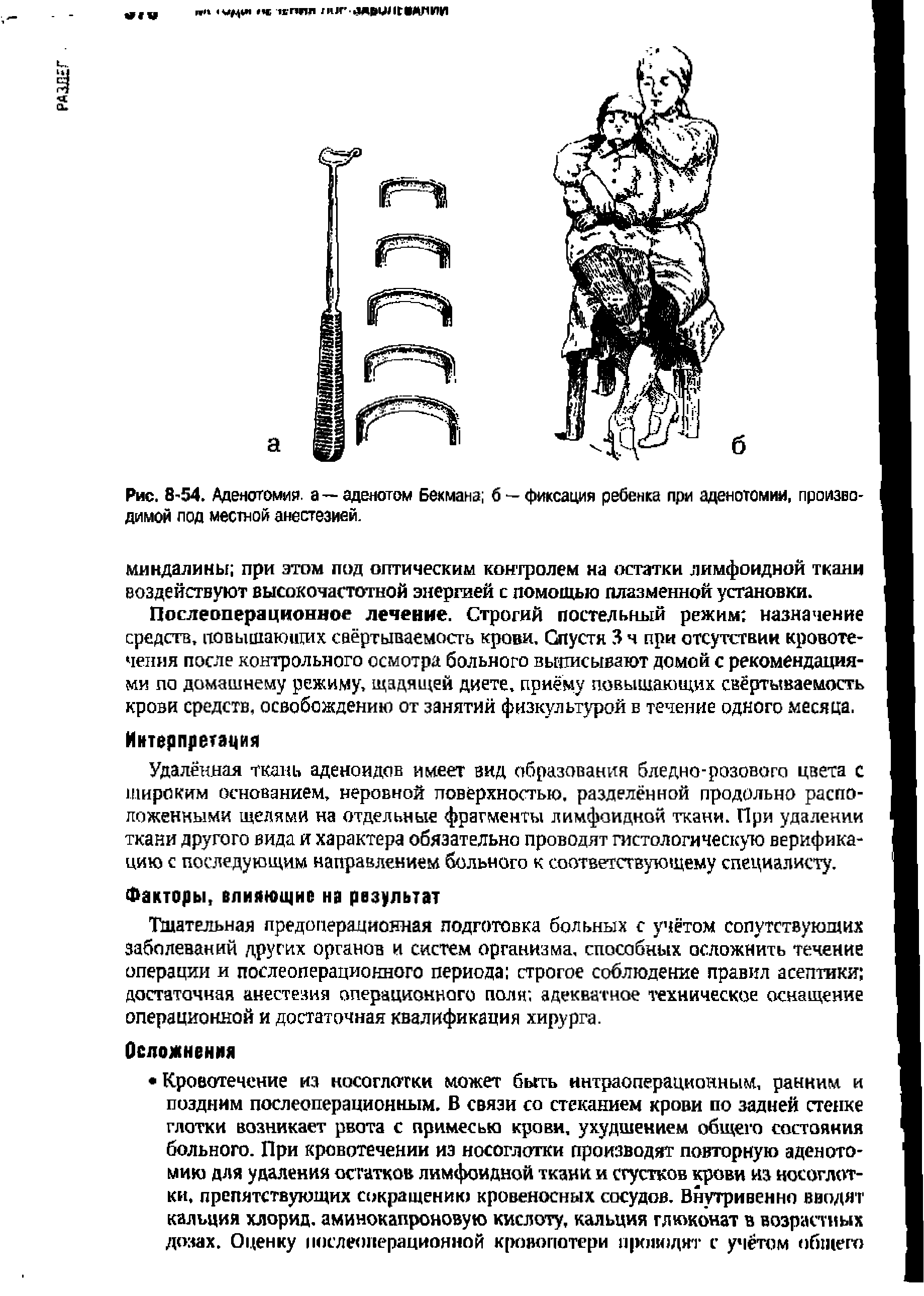 Рис. 8 54. Аденотомия, а—аденотом Бекмана б —фиксация ребенка при аденотомии, производимой под местной анестезией.