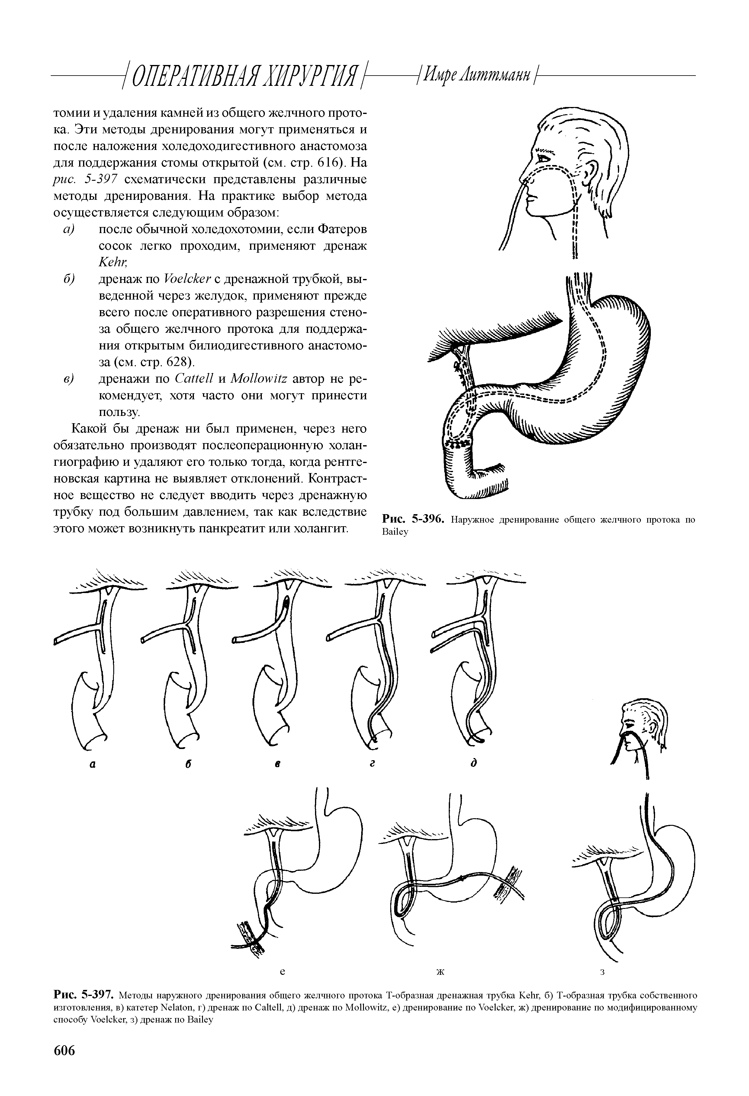 Рис. 5-397. Методы наружного дренирования общего желчного протока Т-образная дренажная трубка K , б) Т-образная трубка собственного изготовления, в) катетер N , г) дренаж по C , д) дренаж по M , е) дренирование по V , ж) дренирование по модифицированному способу V , з) дренаж по B ...