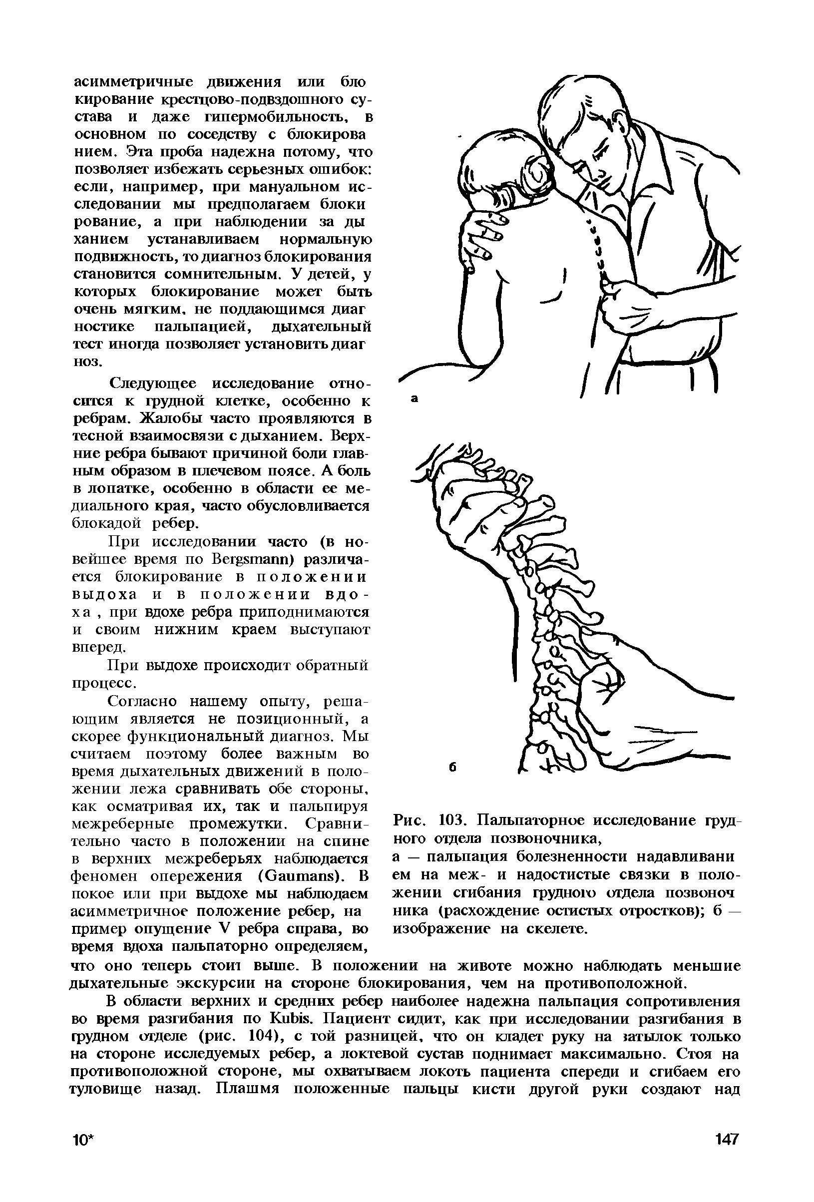 Рис. 103. Пальпаторное исследование грудного отдела позвоночника, а — пальпация болезненности надавливани ем на меж- и надостистые связки в положении сгибания грудною отдела позвоноч ника (расхождение остистых отростков) б — изображение на скелете.