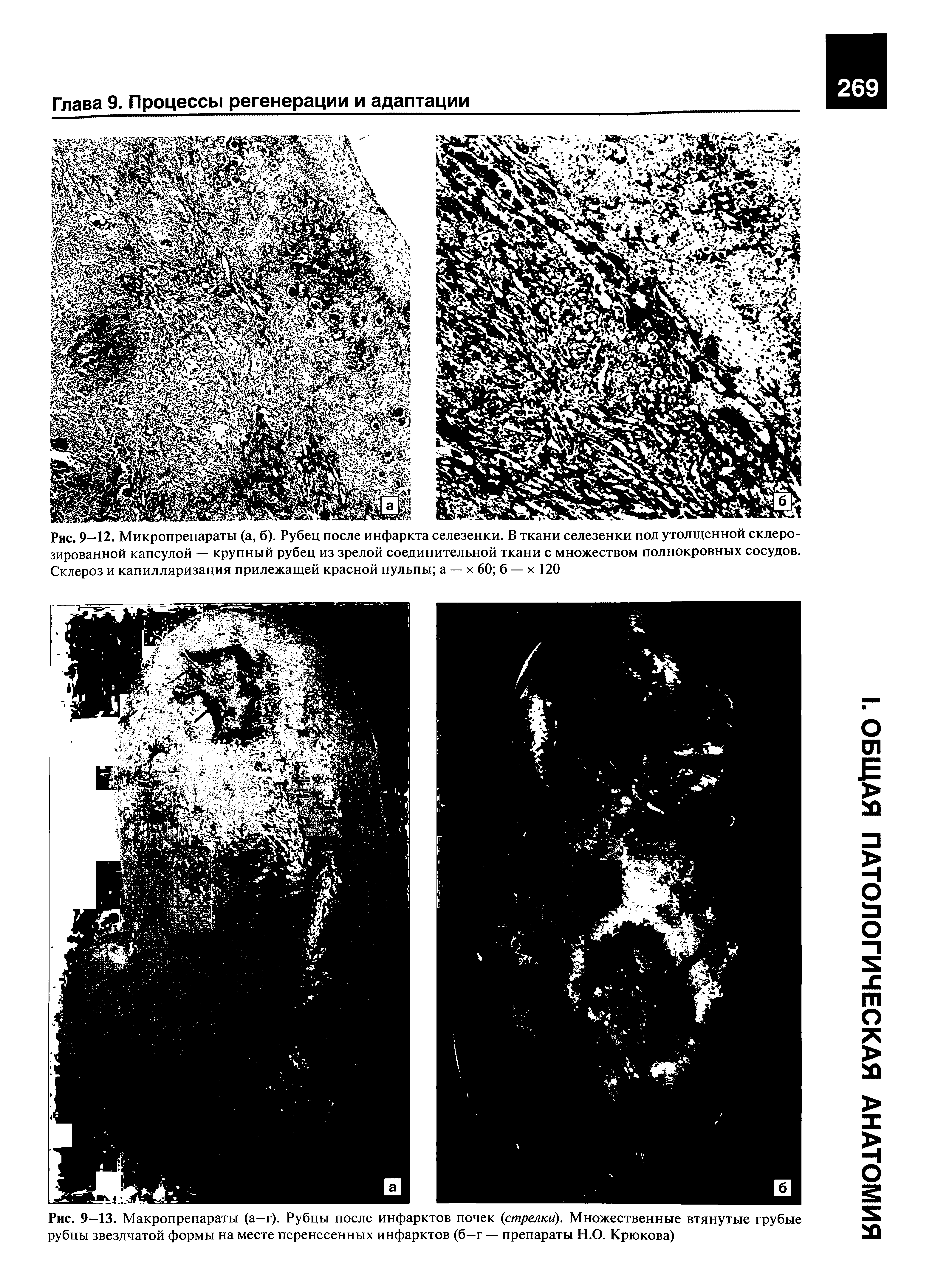 Рис. 9-13. Макропрепараты (а-г). Рубцы после инфарктов почек (стрелки). Множественные втянутые грубые рубцы звездчатой формы на месте перенесенных инфарктов (б—г — препараты Н.О. Крюкова)...