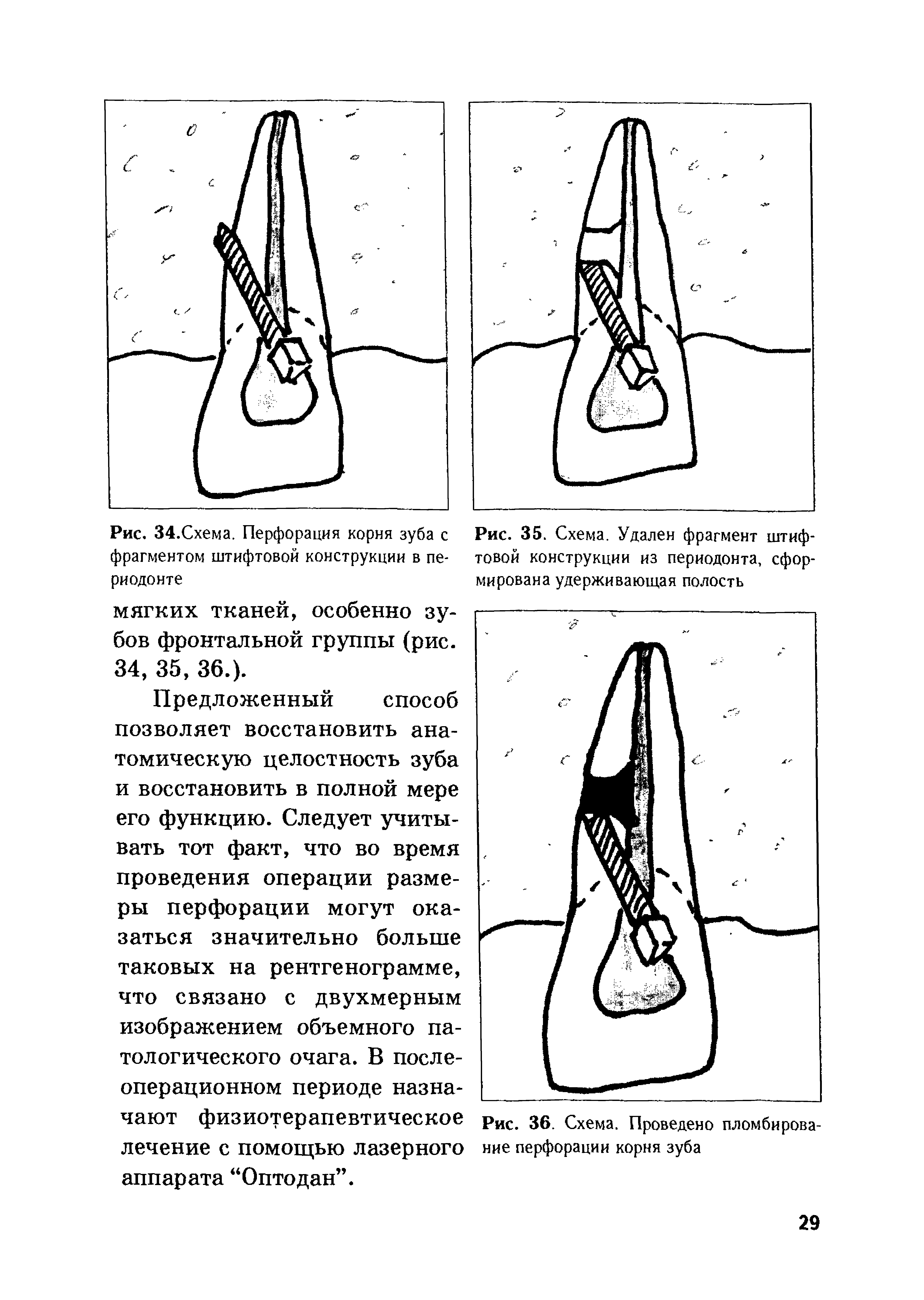 Рис. 34.Схема. Перфорация корня зуба с фрагментом штифтовой конструкции в периодонте...