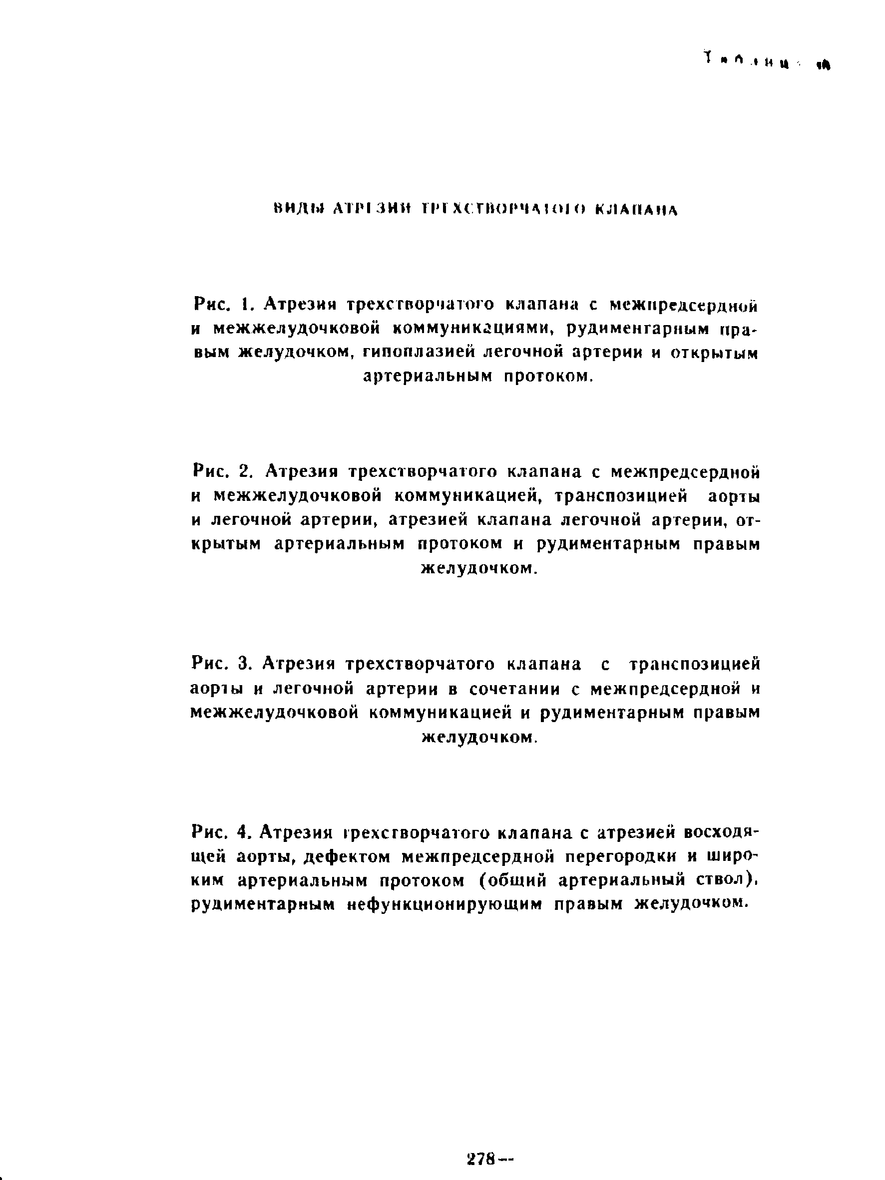 Рис. 4. Атрезия грехсгворчатого клапана с атрезией восходящей аорты, дефектом межпредсердной перегородки и широким артериальным протоком (общий артериальный ствол), рудиментарным нефункционирующим правым желудочком.