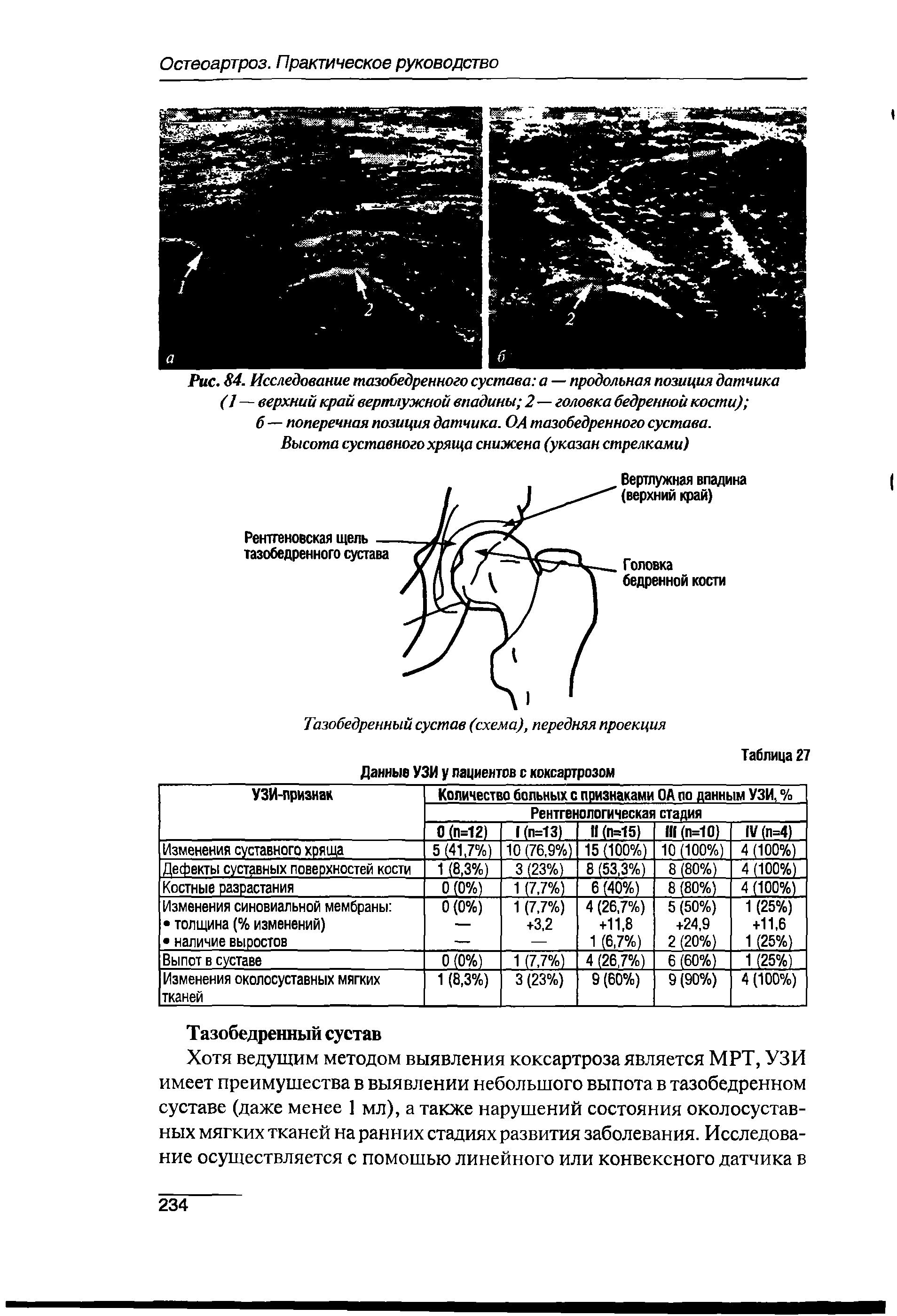 Рис. 84. Исследование тазобедренного сустава а — продольная позиция датчика (1—верхний край вертлужной впадины 2—головка бедренной кости) ...