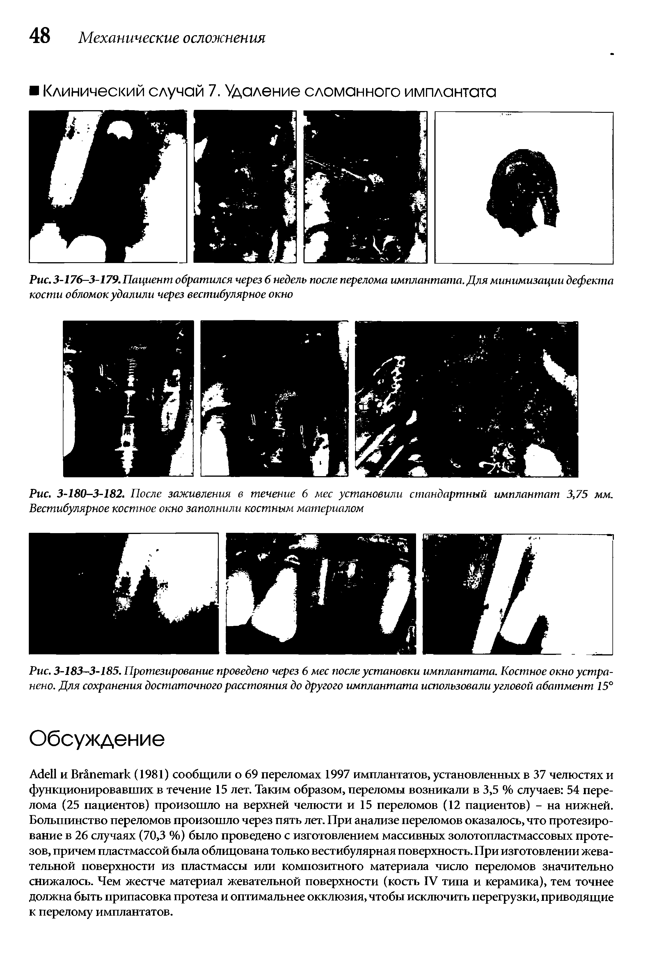 Рис. 3-183-3-185. Протезирование проведено через 6 мес после установки имплантата. Костное окно устранено. Для сохранения достаточного расстояния до другого имплантата использовали угловой абатмент 15°...