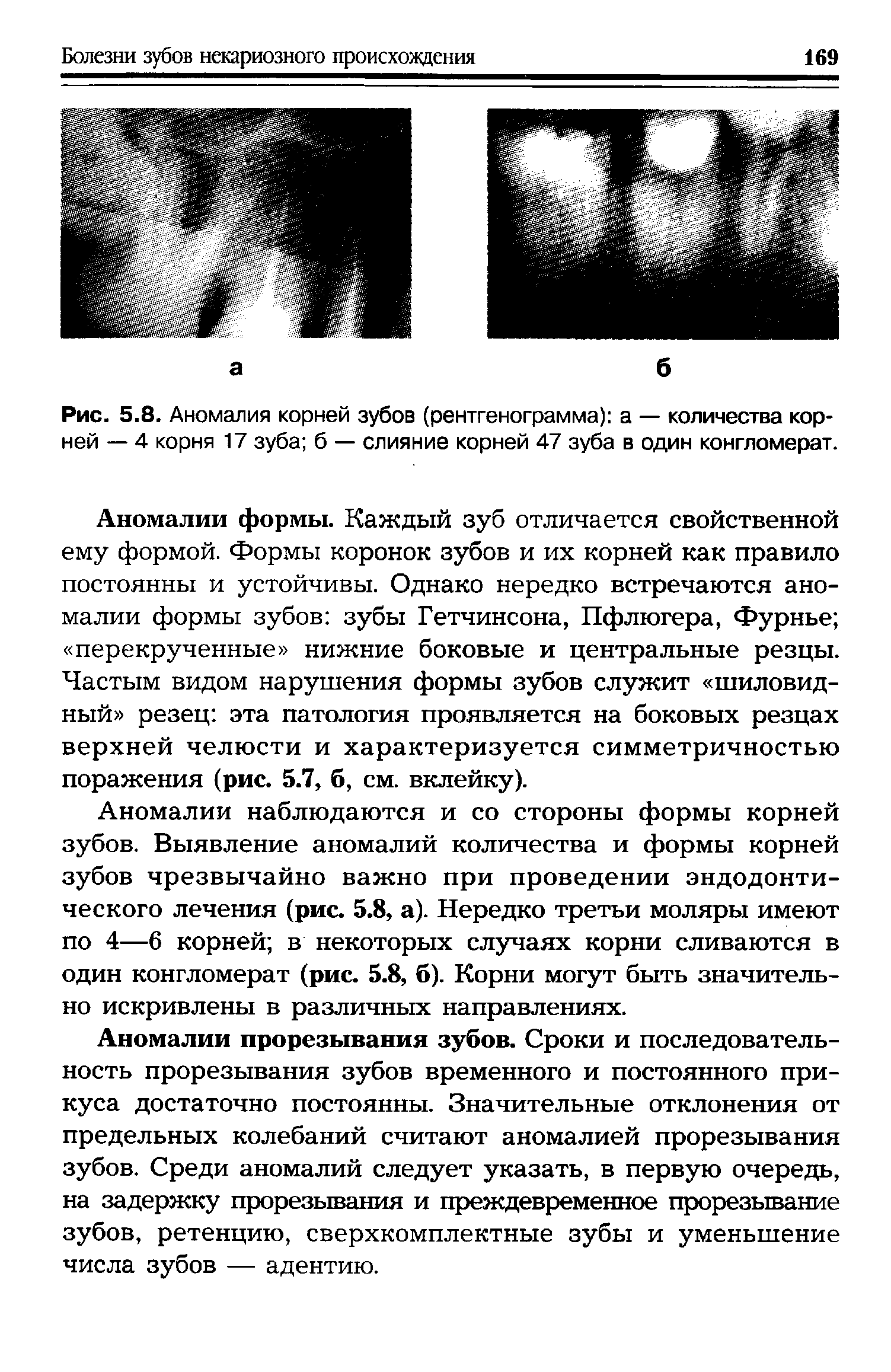 Рис. 5.8. Аномалия корней зубов (рентгенограмма) а — количества корней — 4 корня 17 зуба б — слияние корней 47 зуба в один конгломерат.