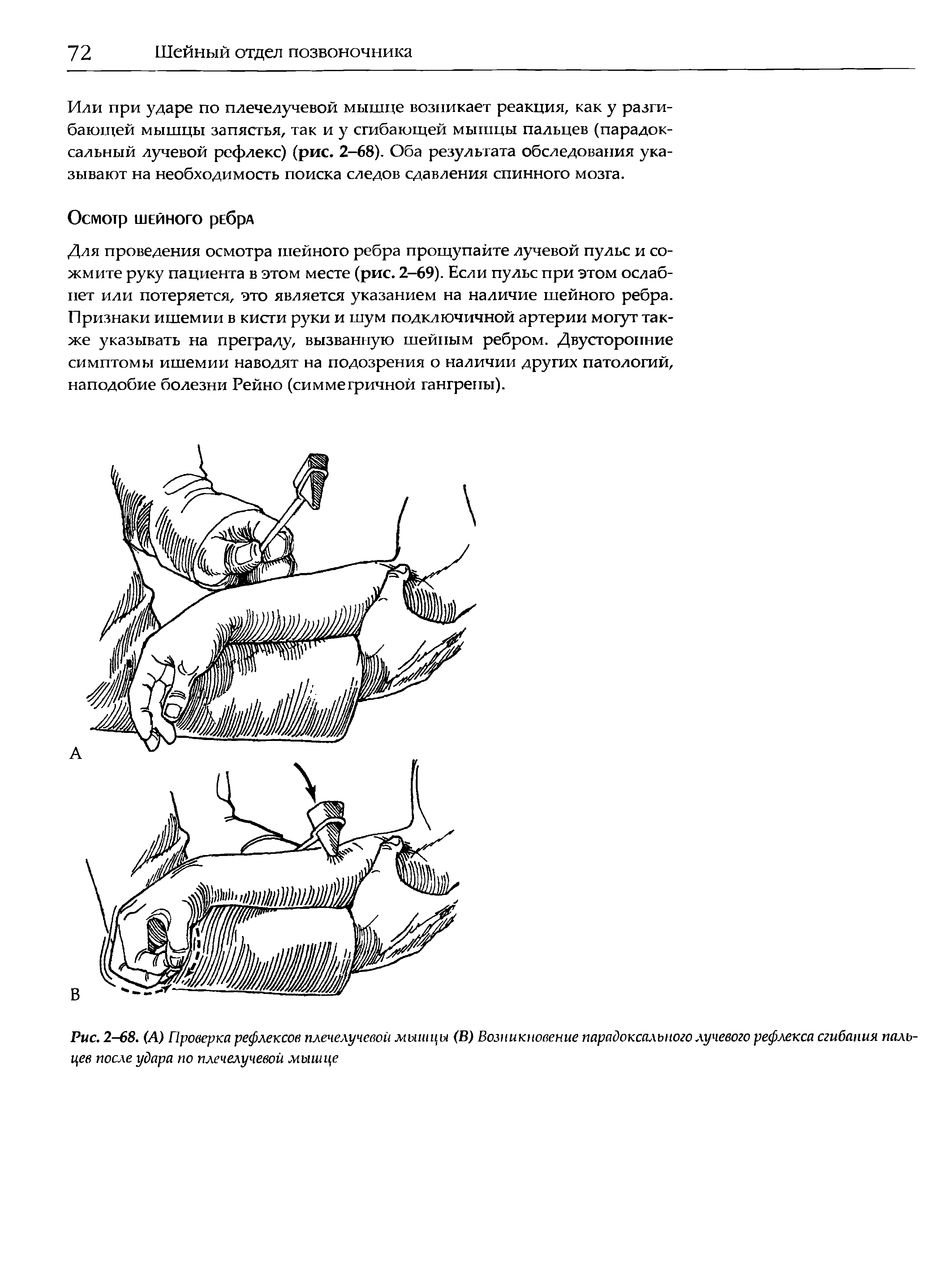 Рис. 2-68. (А) Проверка рефлексов плечелучевой мышцы (В) Возникновение парадоксального лучевого реф>лекса сгибания пальцев после удара по плечелучевой мышце...
