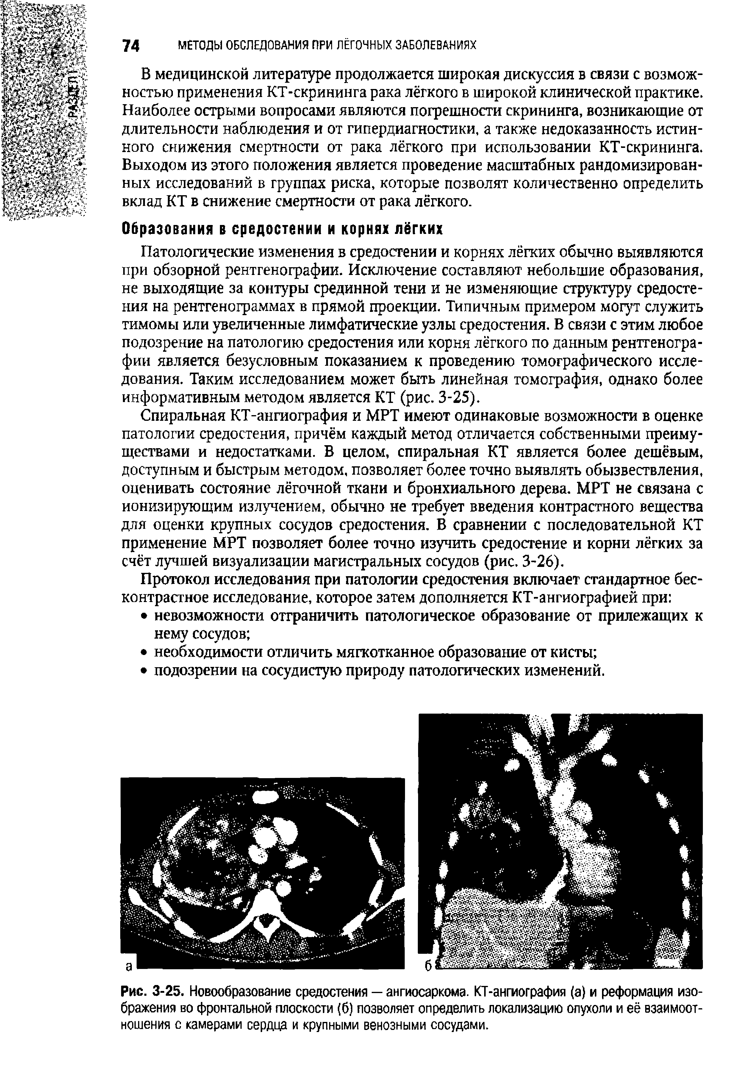 Рис. 3-25. Новообразование средостения — ангиосаркома. КТ-ангиография (а) и реформация изображения во фронтальной плоскости (б) позволяет определить локализацию опухоли и её взаимоотношения с камерами сердца и крупными венозными сосудами.