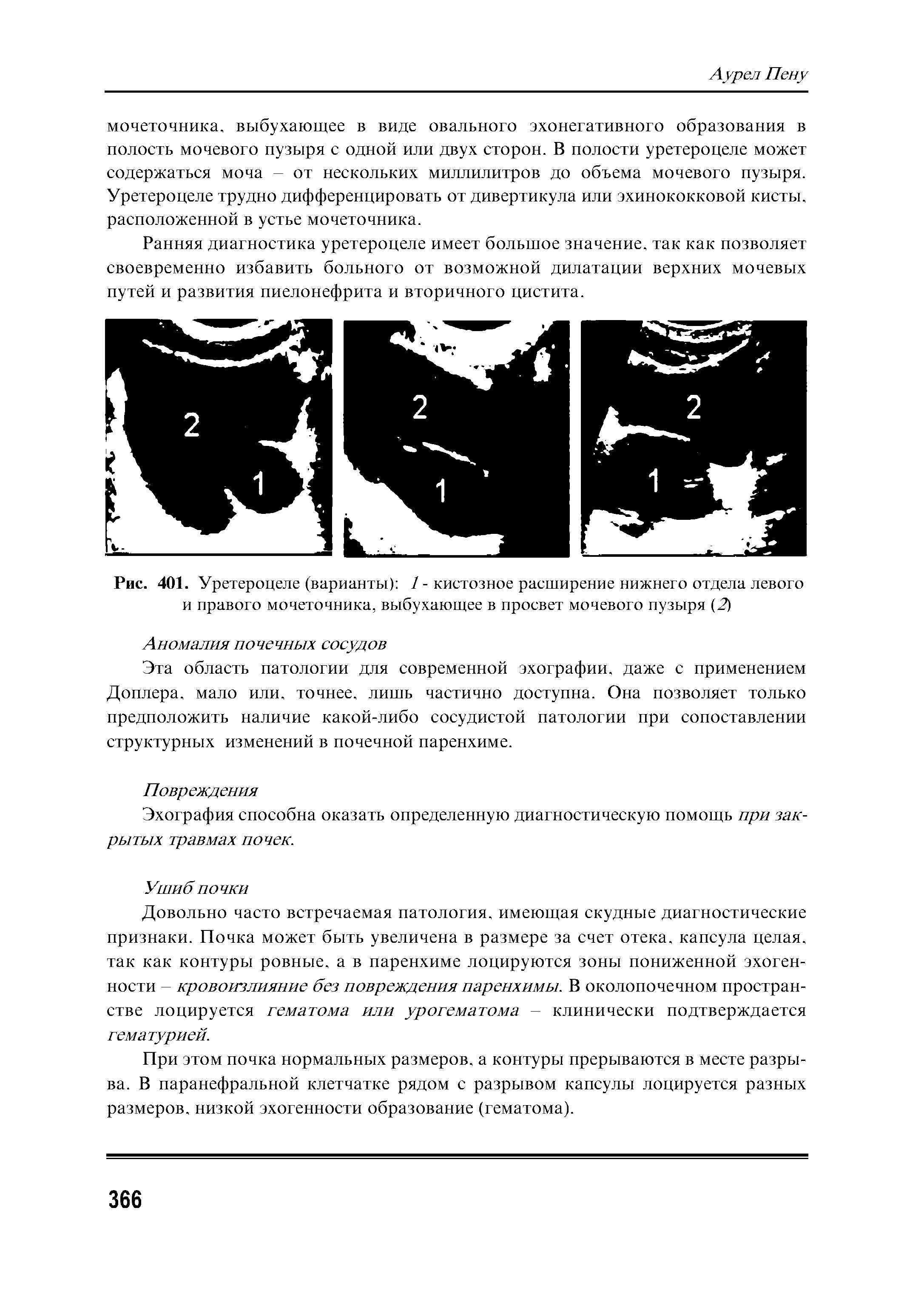 Рис. 401. Уретероцеле (варианты) 1- кистозное расширение нижнего отдела левого и правого мочеточника, выбухающее в просвет мочевого пузыря (2)...