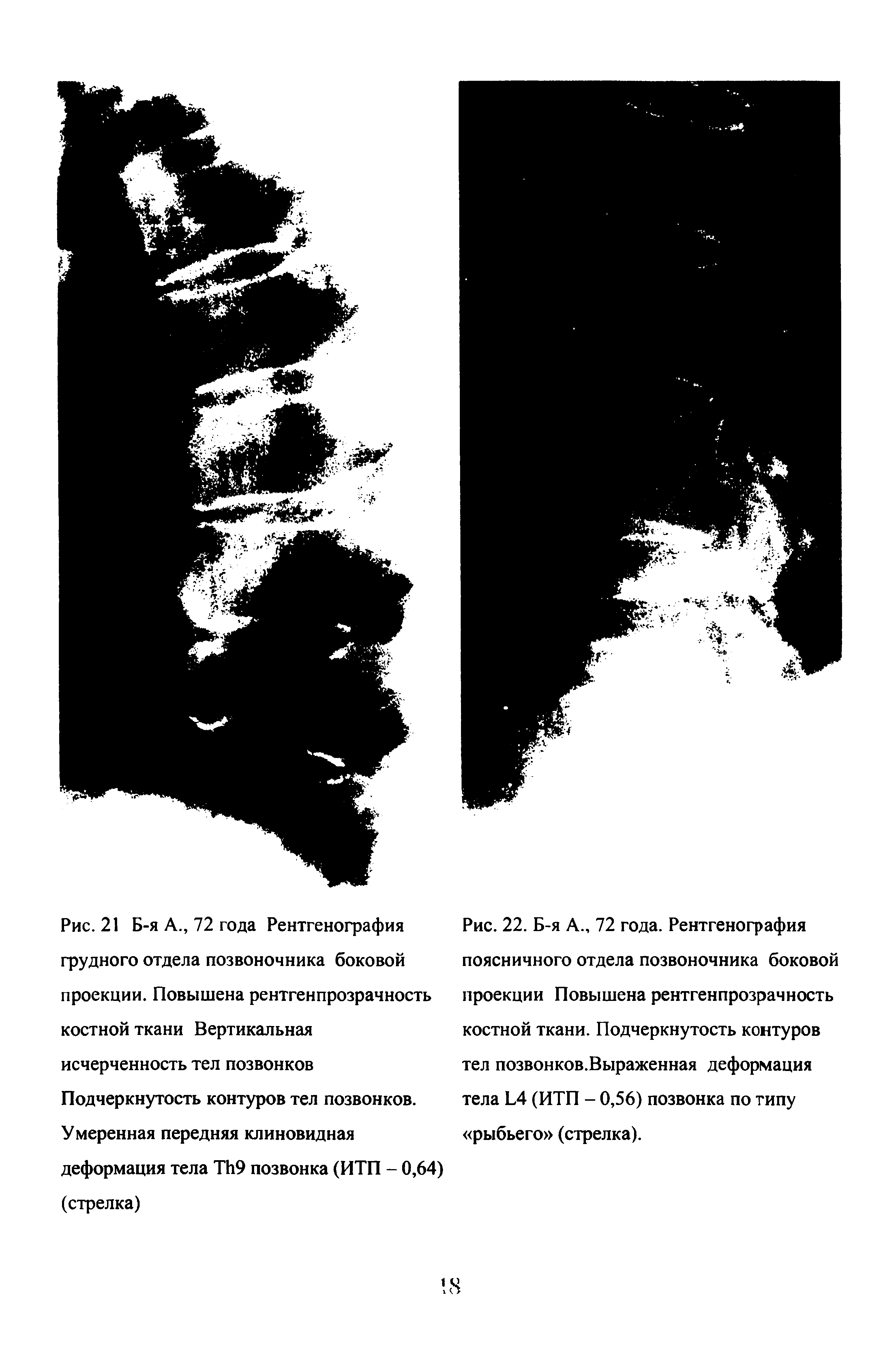 Рис. 22. Б-я А., 72 года. Рентгенография поясничного отдела позвоночника боковой проекции Повышена рентгенпрозрачность костной ткани. Подчеркнутость контуров тел позвонков.Выраженная деформация тела Ь4 (ИТП - 0,56) позвонка по типу рыбьего (стрелка).