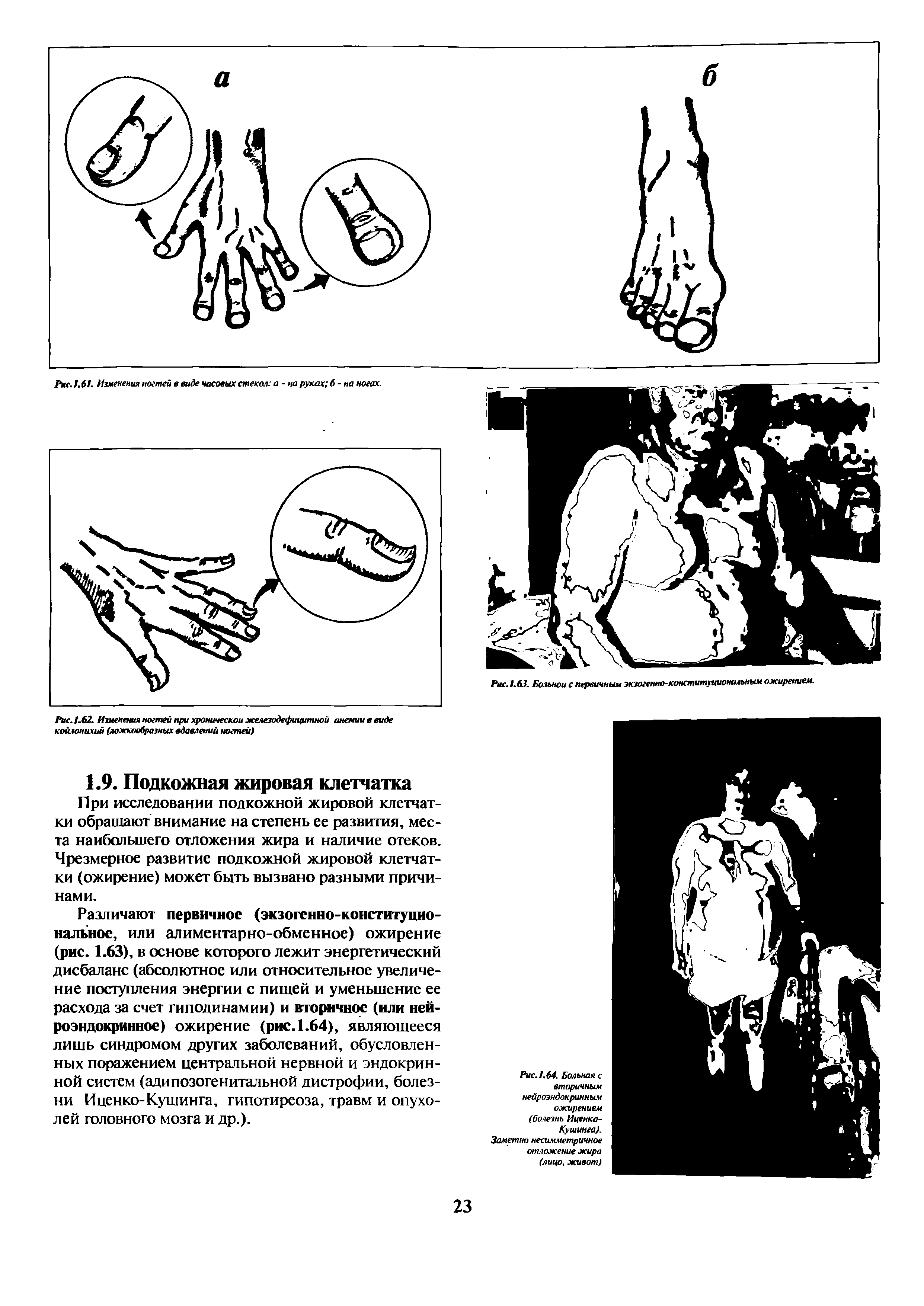 Рис.1.64. Больная с вторичным нейроэндокринным ожирением (болезнь Иценка-Кушинга). Заметно несимметричное отложение жира (лицо, живот)...