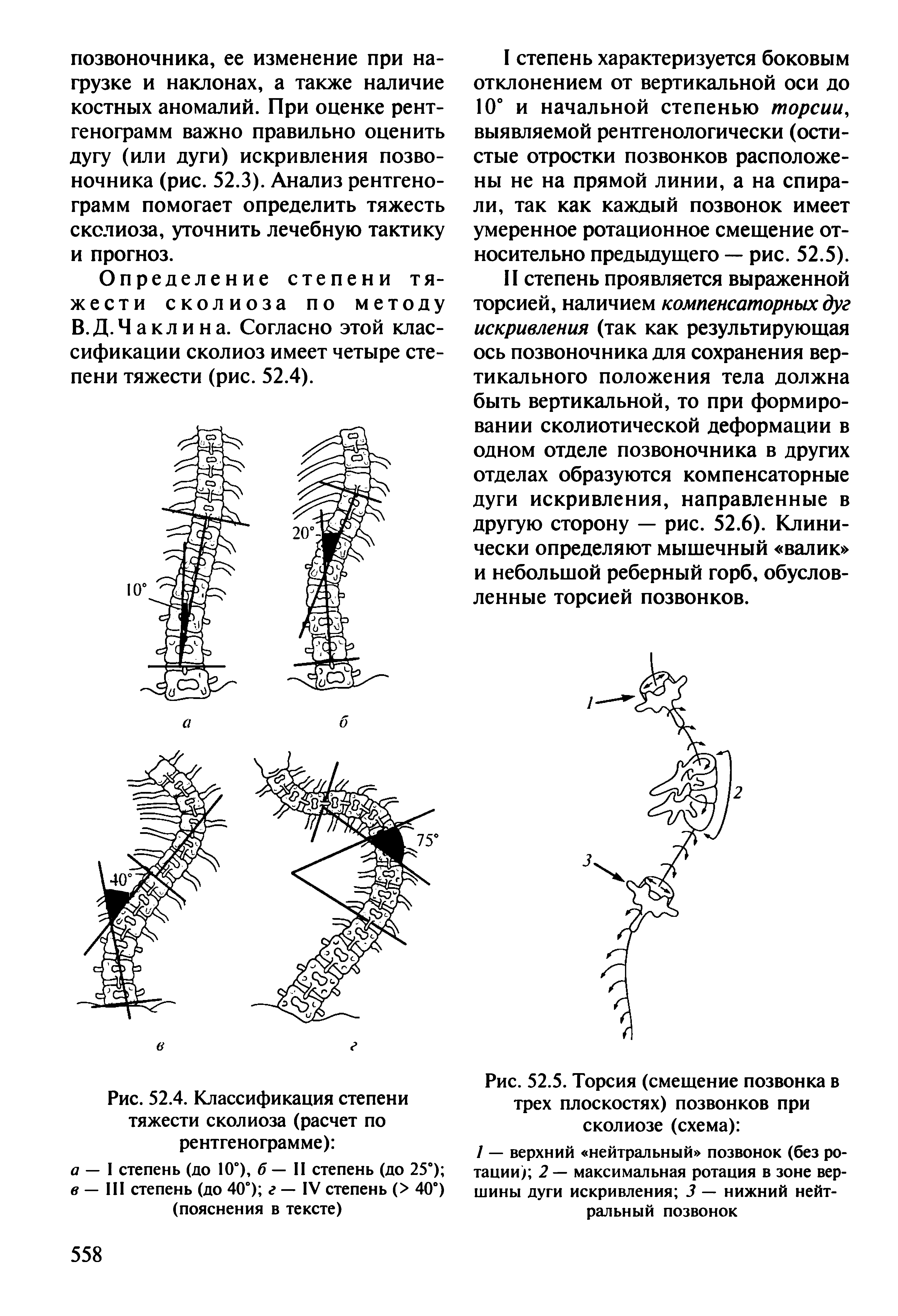 Рис. 52.4. Классификация степени тяжести сколиоза (расчет по рентгенограмме) ...