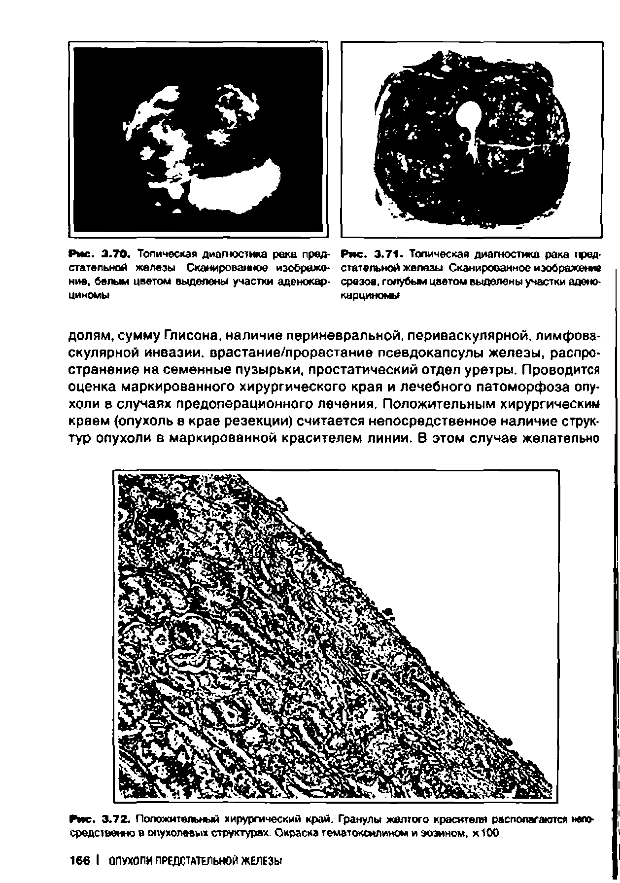 Рис. 3.71. Топическая диагностика рака тред-ствтельной железы Сканированное изображение срезов, голубым цветом выделены участки аде -...