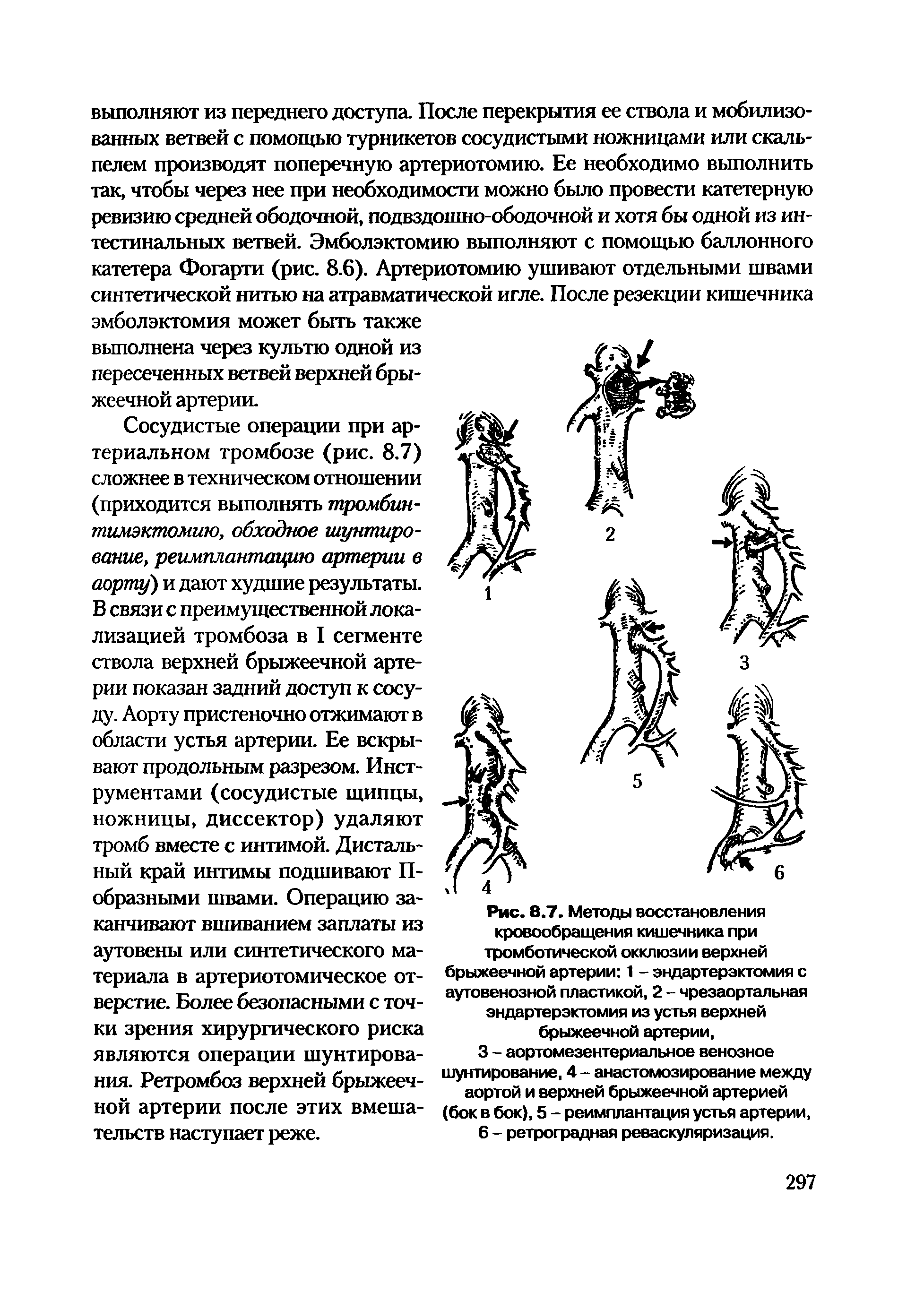 Рис. 8.7. Методы восстановления кровообращения кишечника при тромботической окклюзии верхней брыжеечной артерии 1 - эндартерэктомия с аутовенозной пластикой, 2 - чрезаортальная эндартерэктомия из устья верхней брыжеечной артерии,...