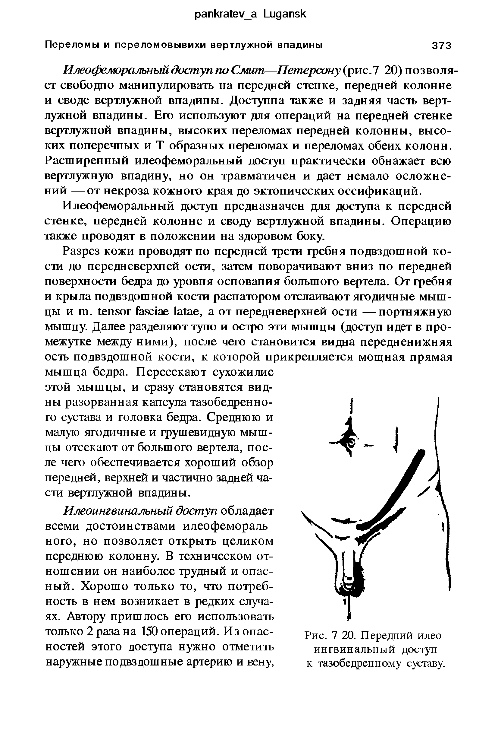 Рис. 7 20. Передний илео ингвинальный доступ к тазобедренному суставу.