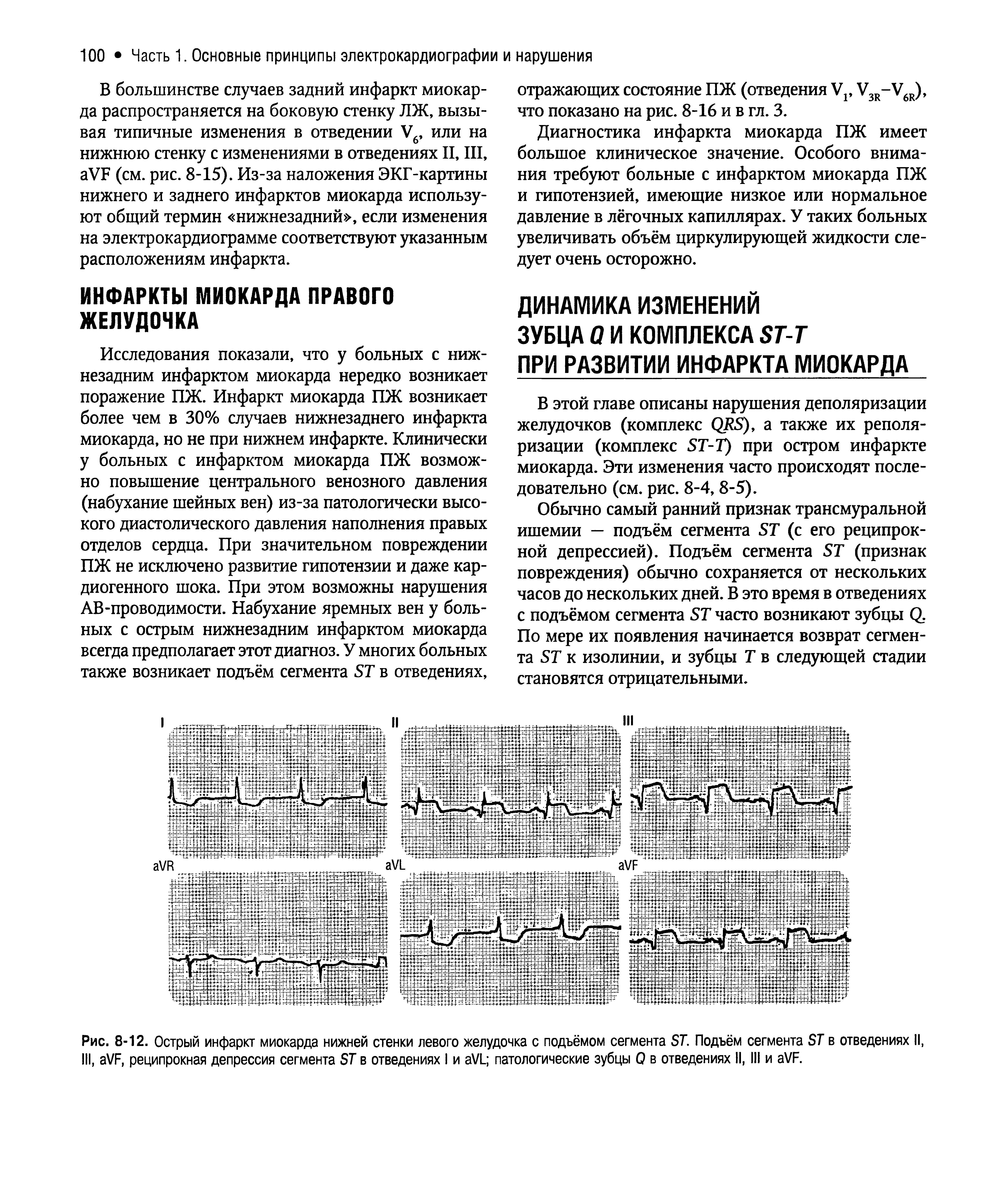 Рис. 8-12. Острый инфаркт миокарда нижней стенки левого желудочка с подъёмом сегмента БТ. Подъём сегмента БТ в отведениях II, III, аУР, реципрокная депрессия сегмента БТ в отведениях I и аУ1 патологические зубцы 0 в отведениях II, III и аУГ...