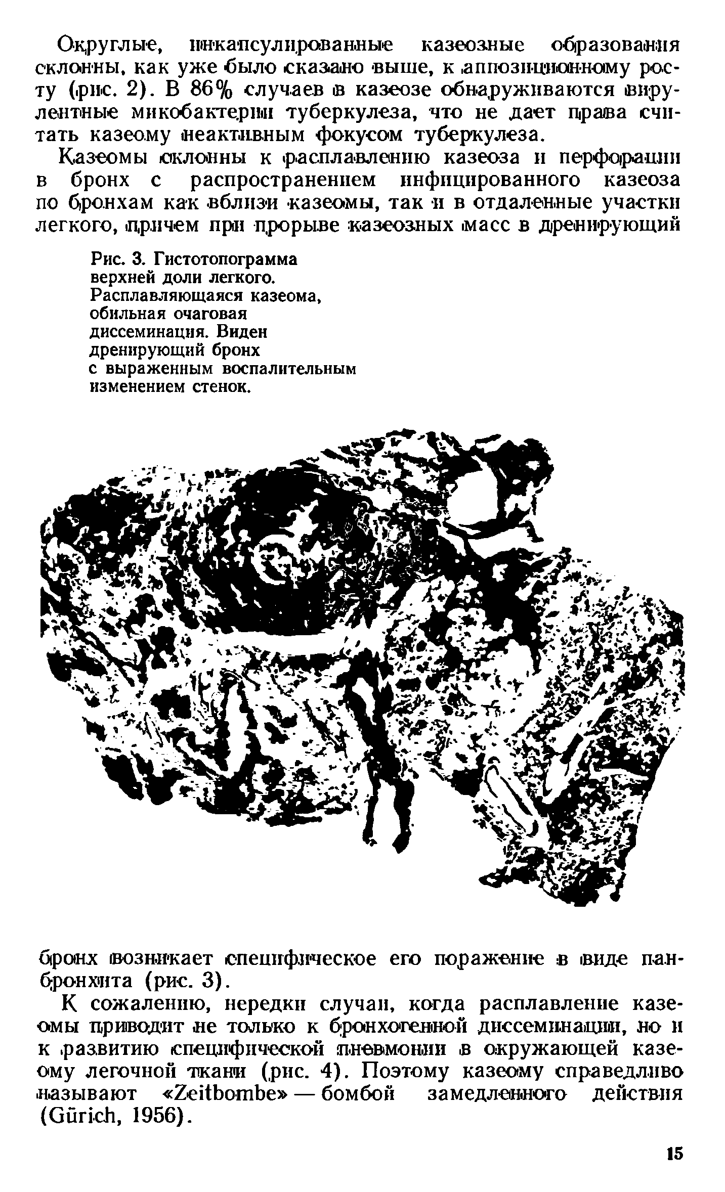 Рис. 3. Гистотопограмма верхней доли легкого. Расплавляющаяся казеома, обильная очаговая диссеминация. Виден дренирующий бронх с выраженным воспалительным изменением стенок.