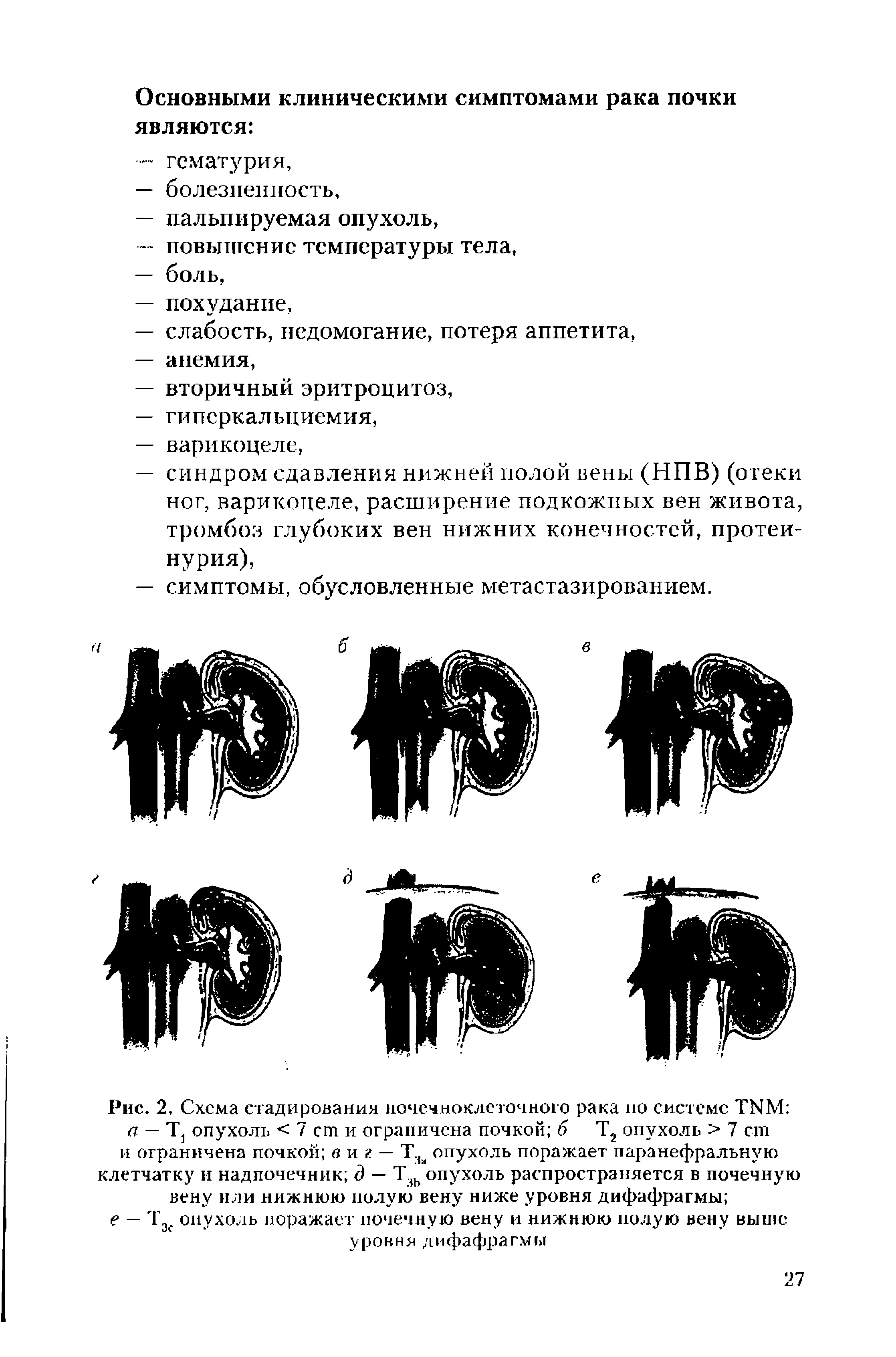 Рис. 2. Схема стадирования почечноклеточного рака но системе ТИМ а — Т1 опухоль < 7 ст и ограничена почкой б Т2 опухоль > 7 ст и ограничена почкой в и г — Т.ь опухоль поражает паранефральную клетчатку и надпочечник д — Тзь опухоль распространяется в почечную вену или нижнюю полую вену ниже уровня дифафрагмы ...