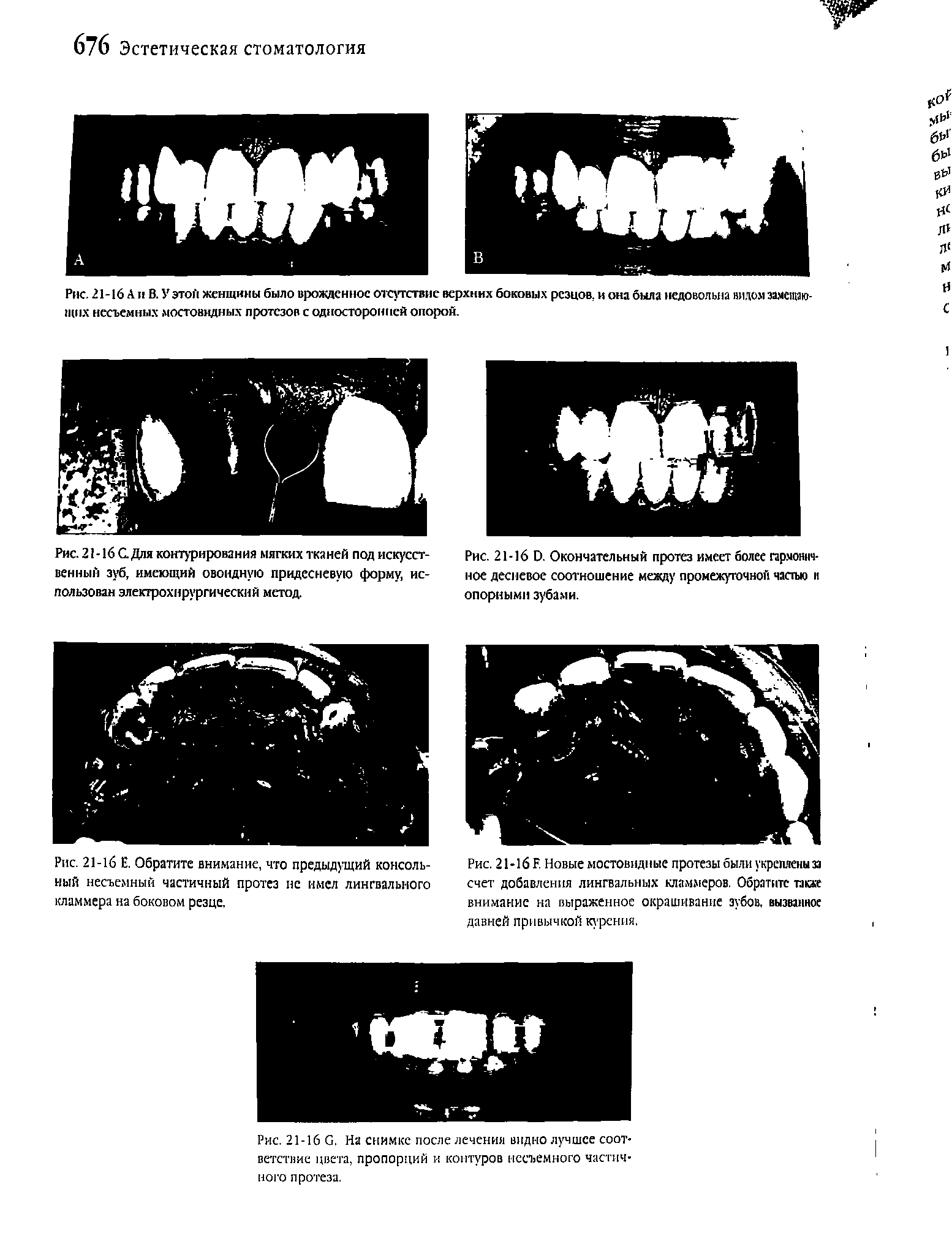 Рис. 21-16 Е. Обратите внимание, что предыдущий консольный несъемный частичный протез нс имел лингвального кламмера на боковом резце.