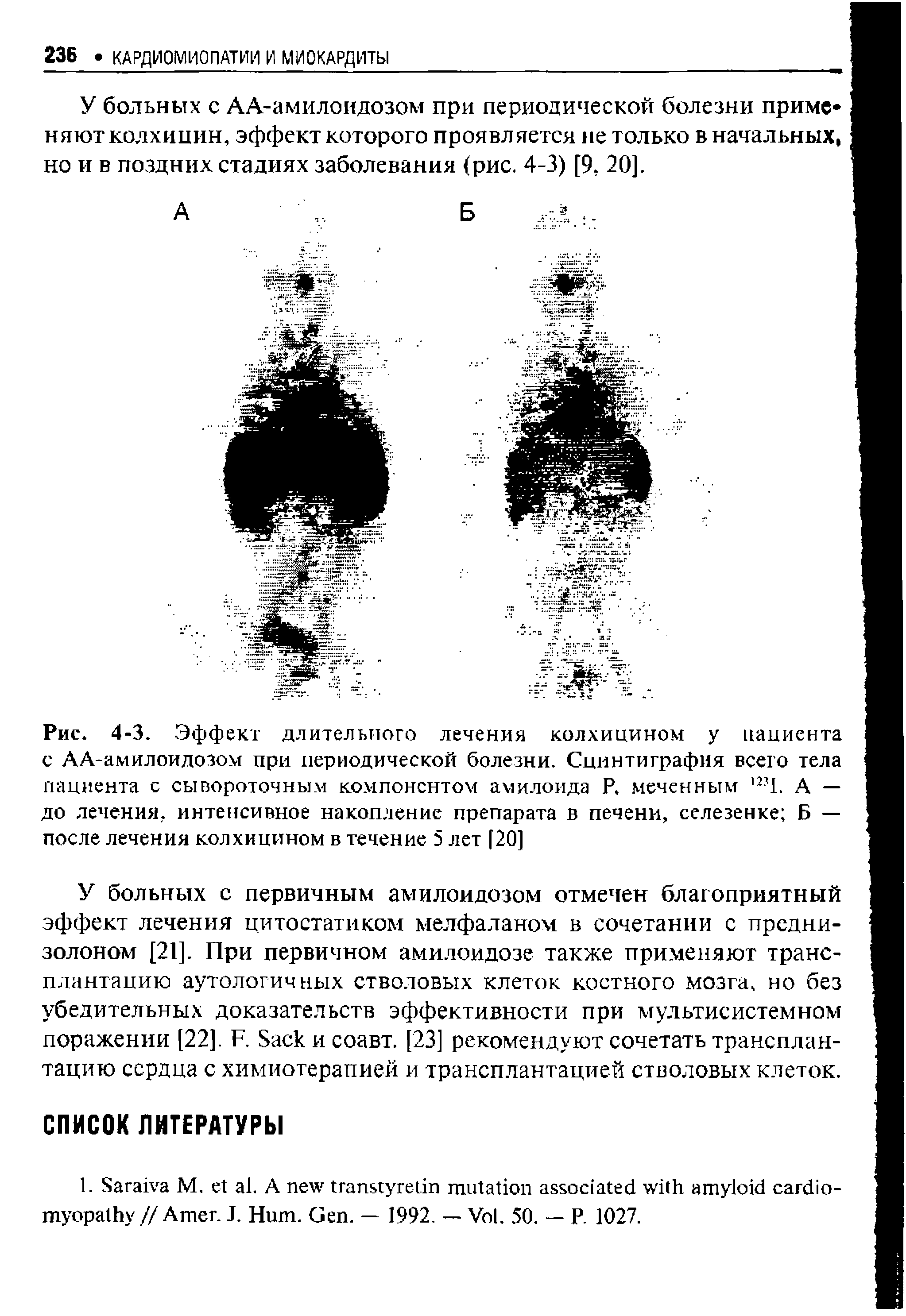 Рис. 4-3. Эффект длительного лечения колхицином у пациента с АА-амилоидозом при периодической болезни. Сцинтиграфия всего тела пациента с сывороточным компонентом амилоида Р. меченным, 271. А — до лечения, интенсивное накопление препарата в печени, селезенке Б — после лечения колхицином в течение 5 лет [20]...