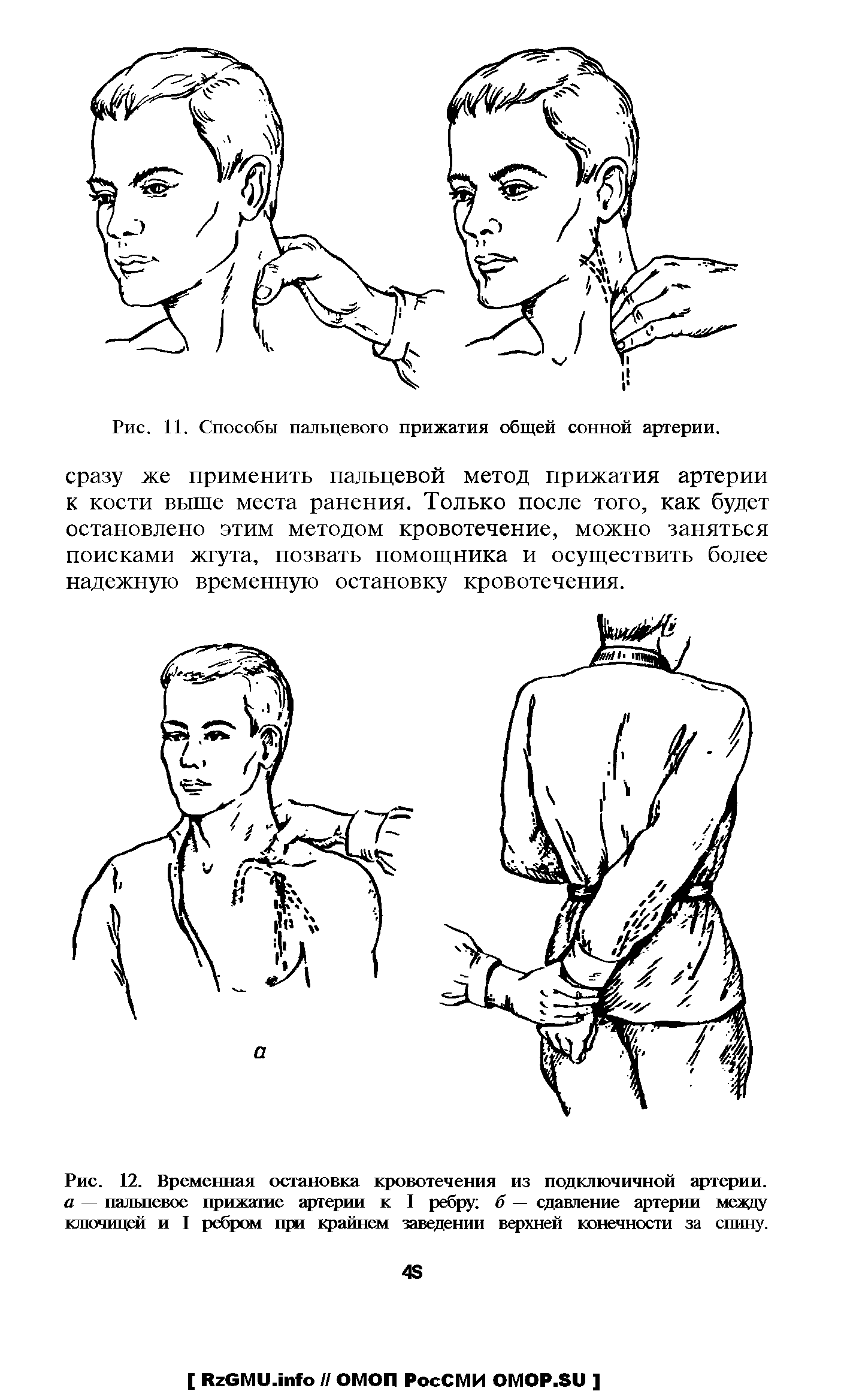 Рис. 12. Временная остановка кровотечения из подключичной артерии. а — пальпевое прижатие артерии к I ребру б — сдавление артерии между ключица и I ребром при крайнем заведении верхней конечности за спину.