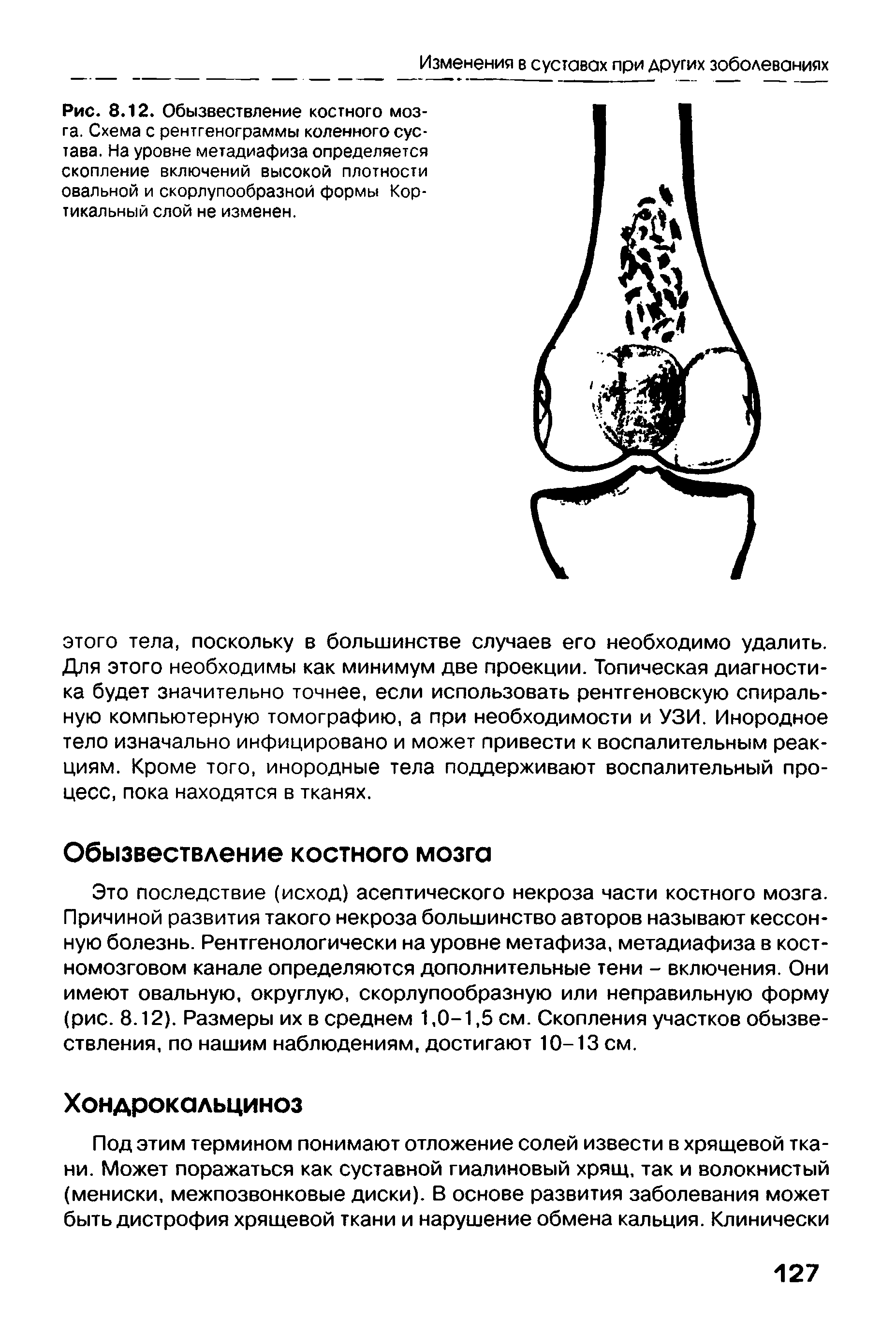 Рис. 8.12. Обызвествление костного мозга. Схема с рентгенограммы коленного сустава. На уровне метадиафиза определяется скопление включений высокой плотности овальной и скорлупообразной формы Кортикальный слой не изменен.