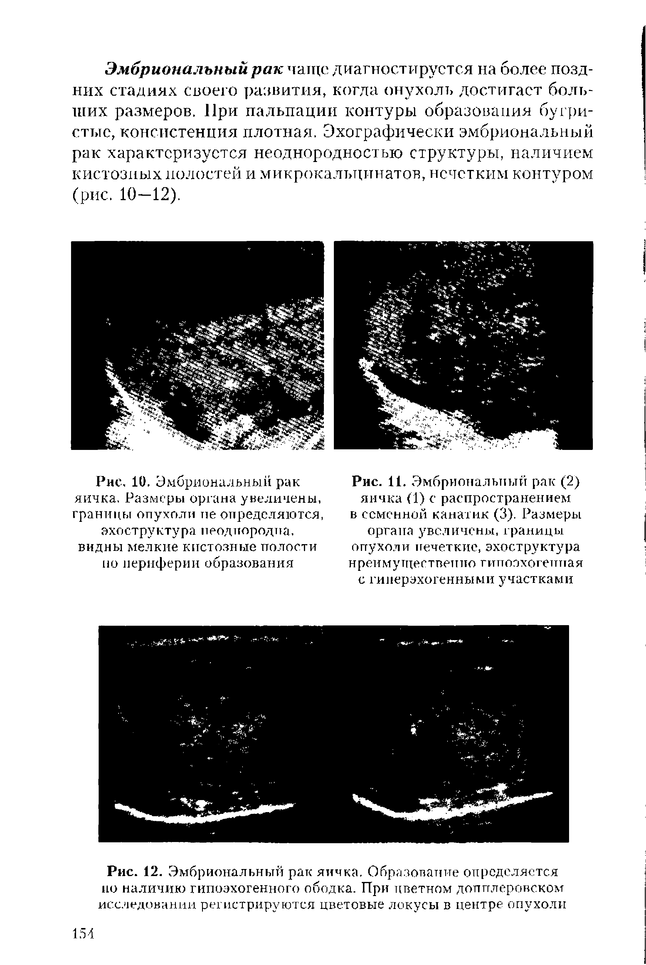 Рис. 12. Эмбриональный рак яичка. Образование определяется но наличию гипоэхогенного ободка. При цветном допплеровском исследовании регистрируются цветовые локусы в центре опухоли...